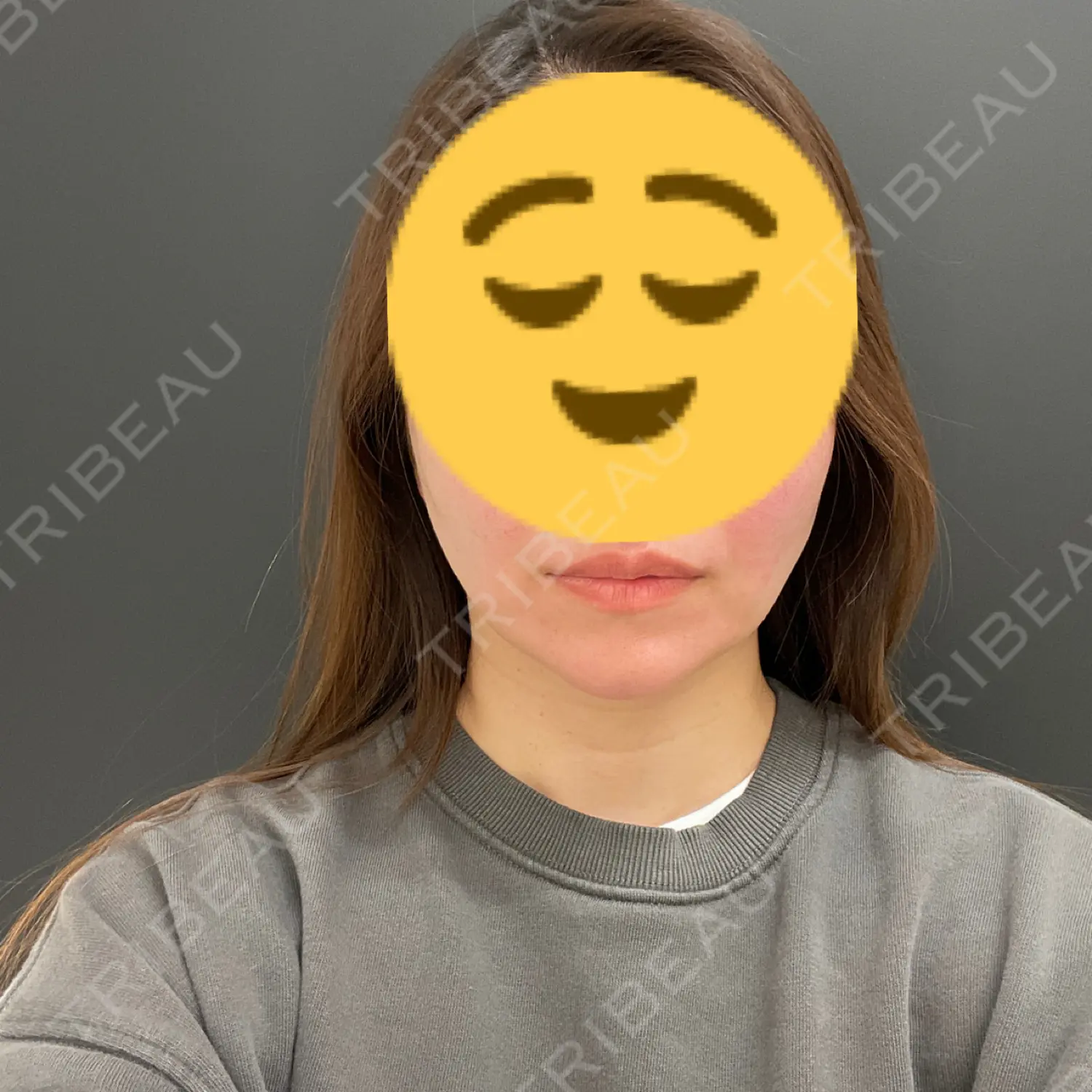 施術後の写真