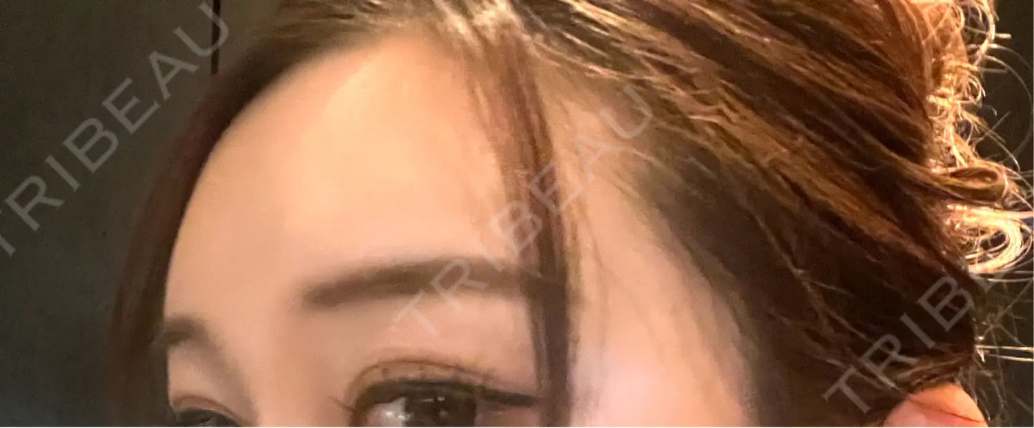 施術後の写真