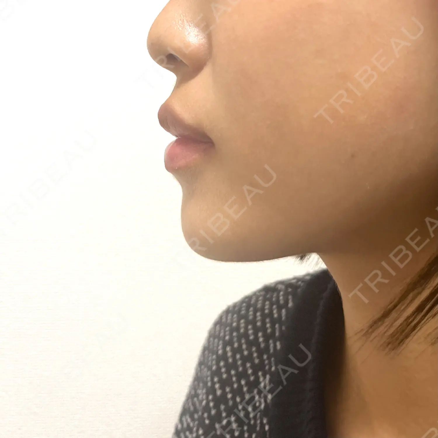 施術後の写真
