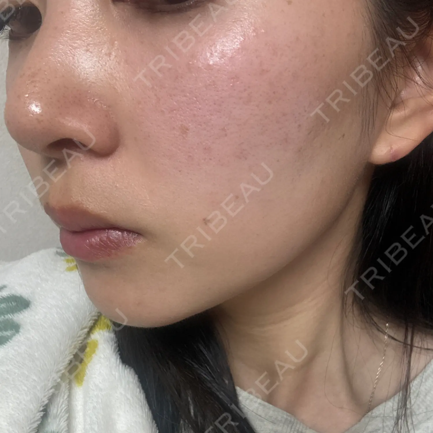 施術後の写真
