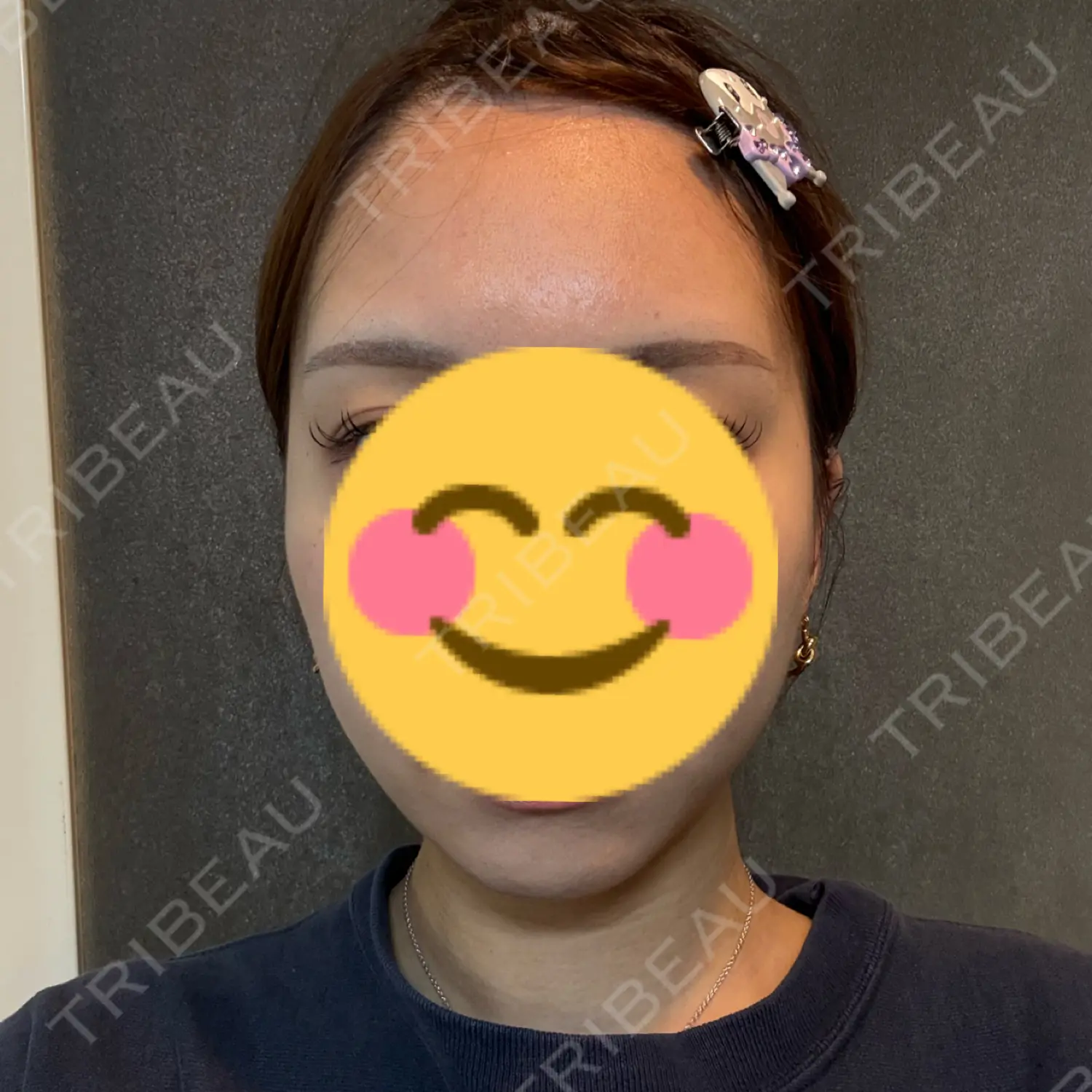 施術後の写真