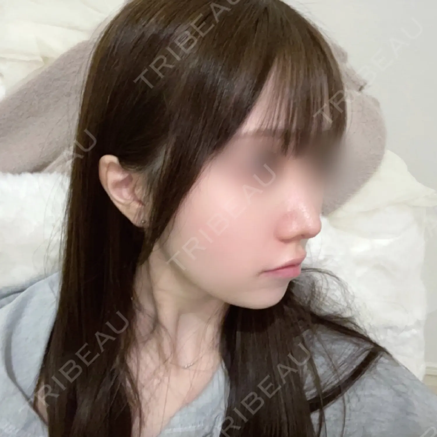 施術後の写真