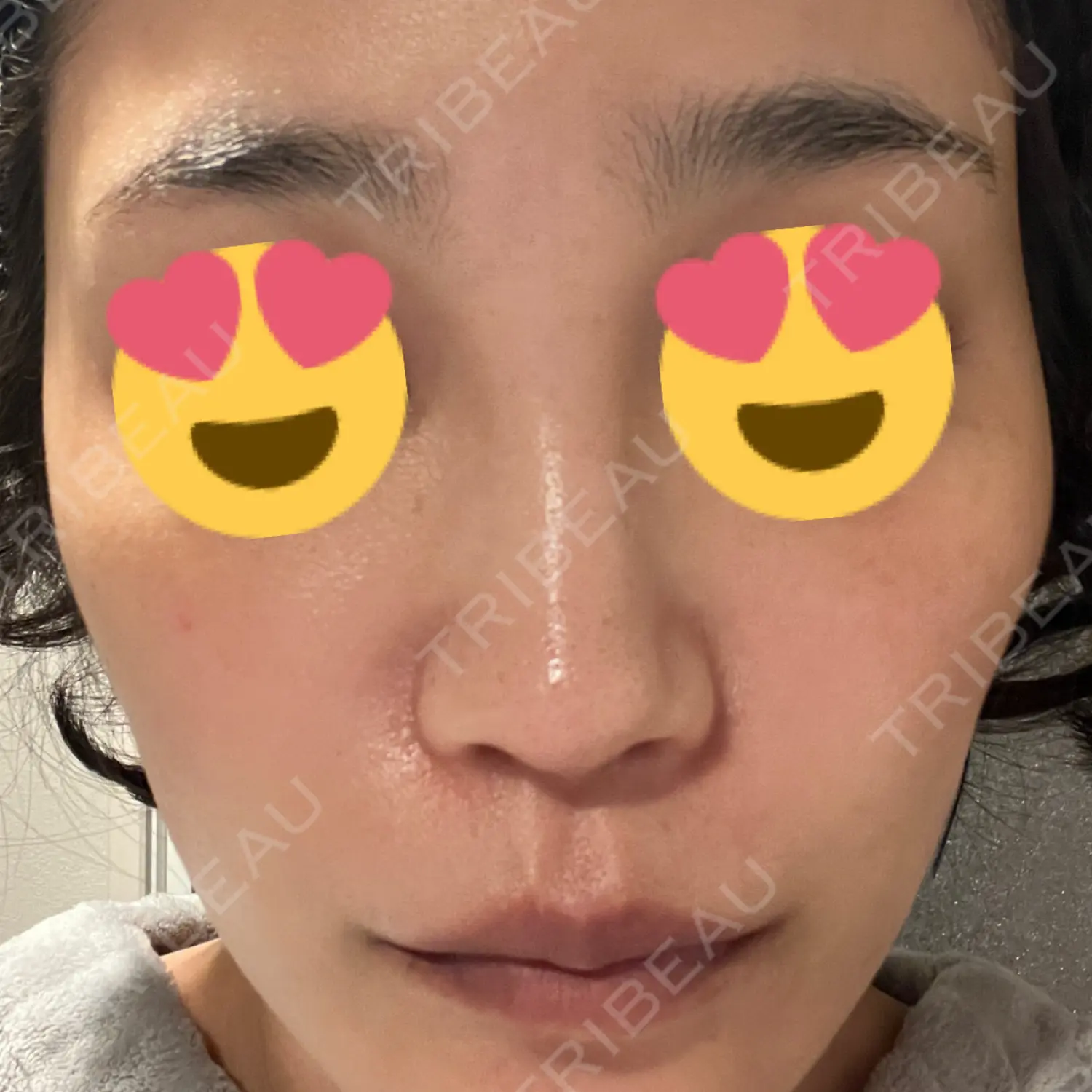 施術後の写真