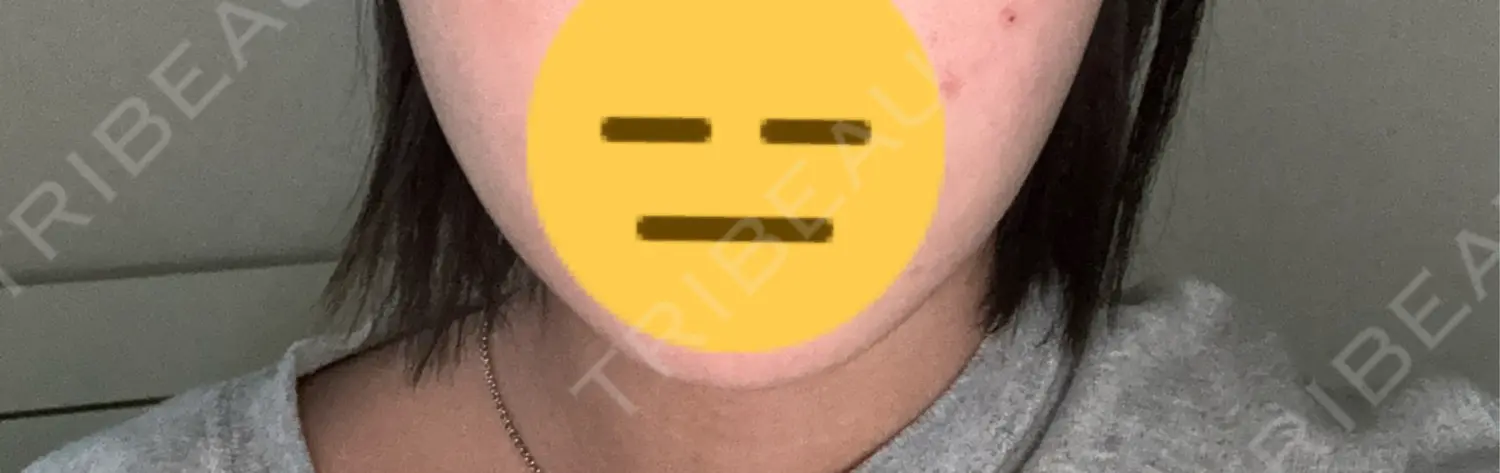 施術後の写真