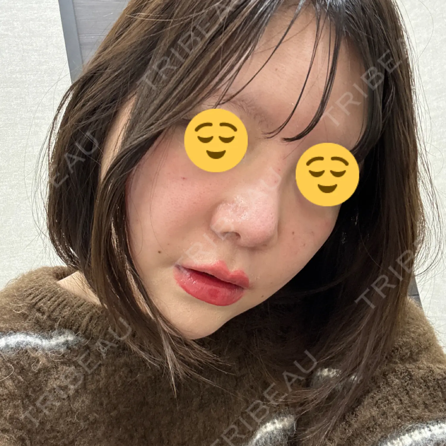 施術後の写真