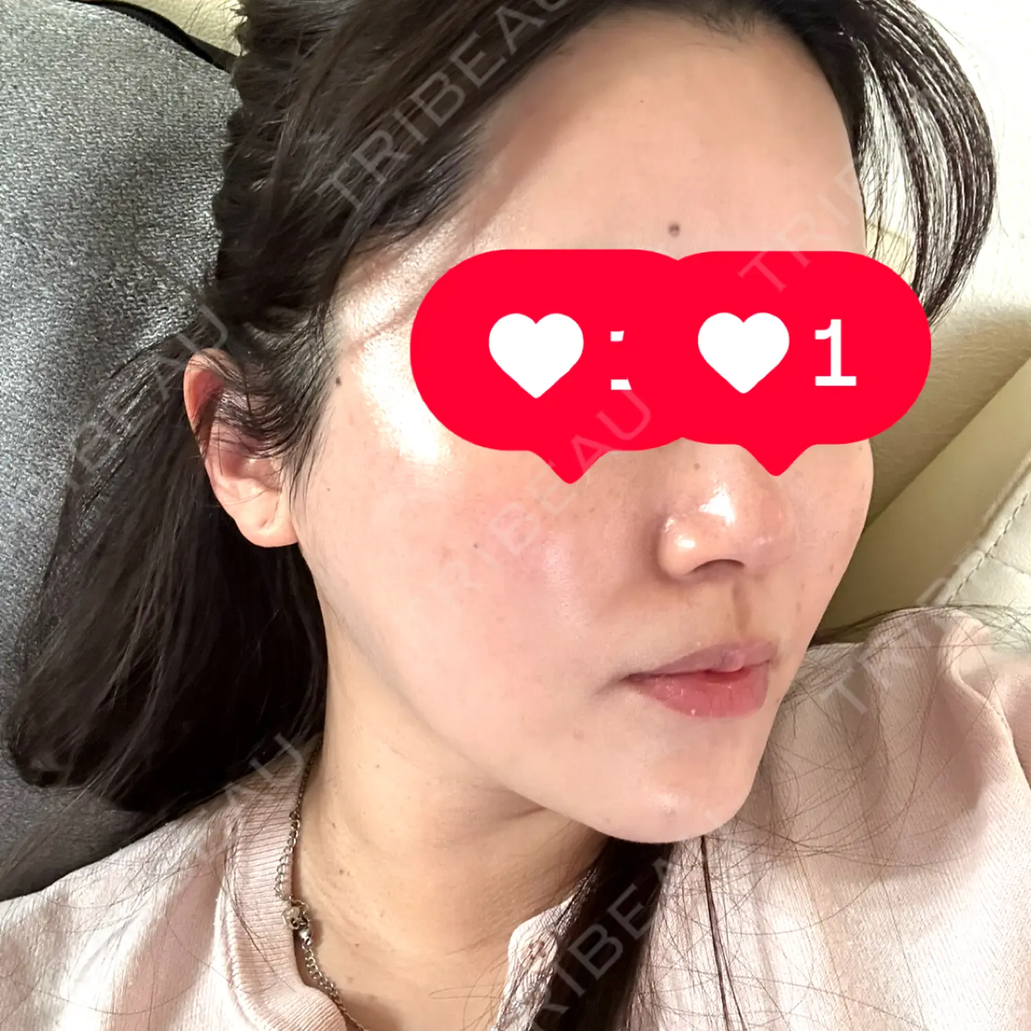 施術後の写真