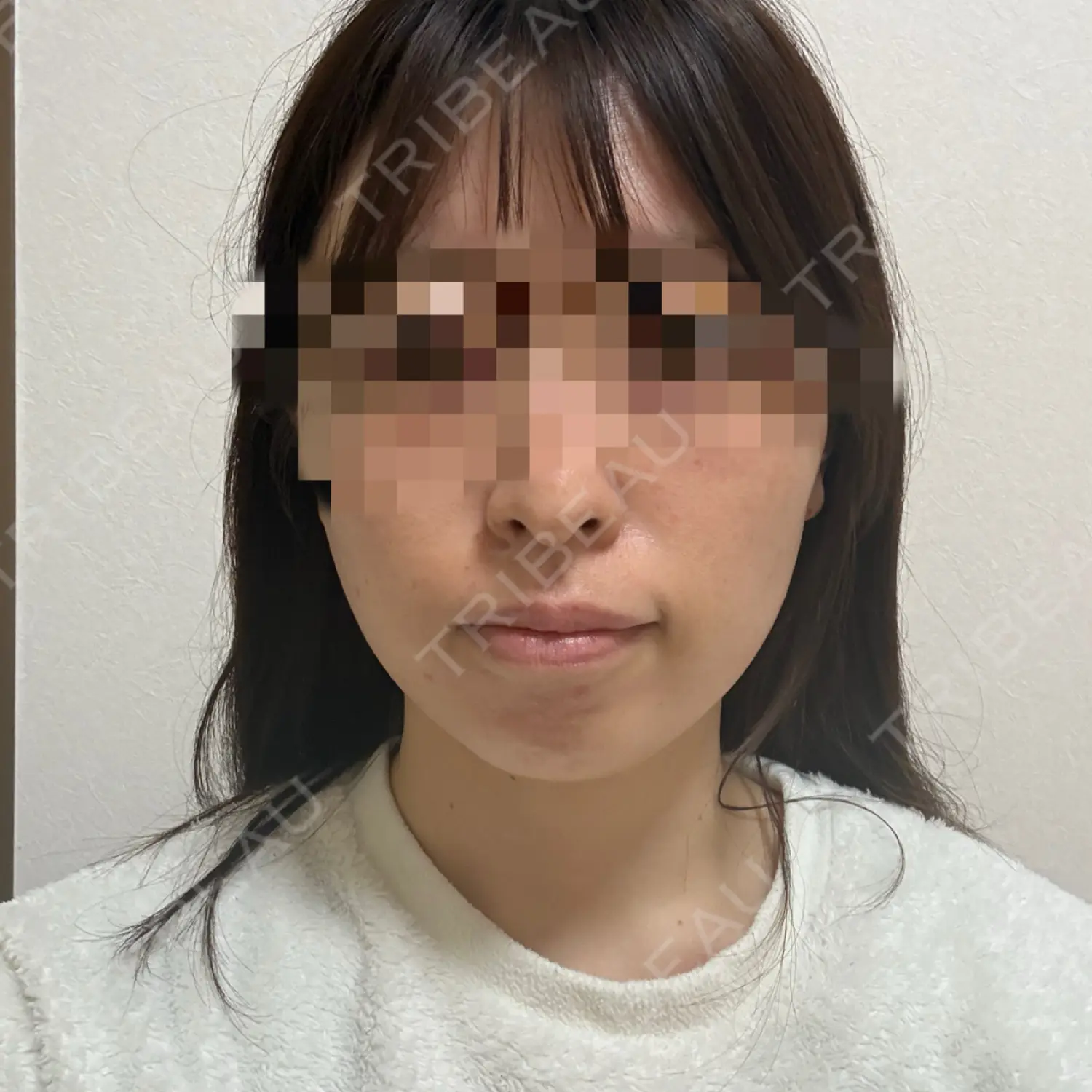 施術後の写真