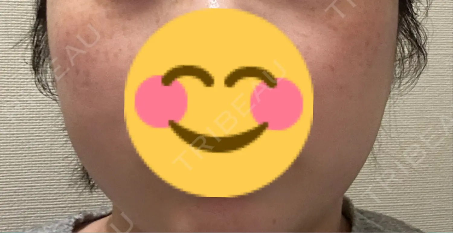 施術後の写真