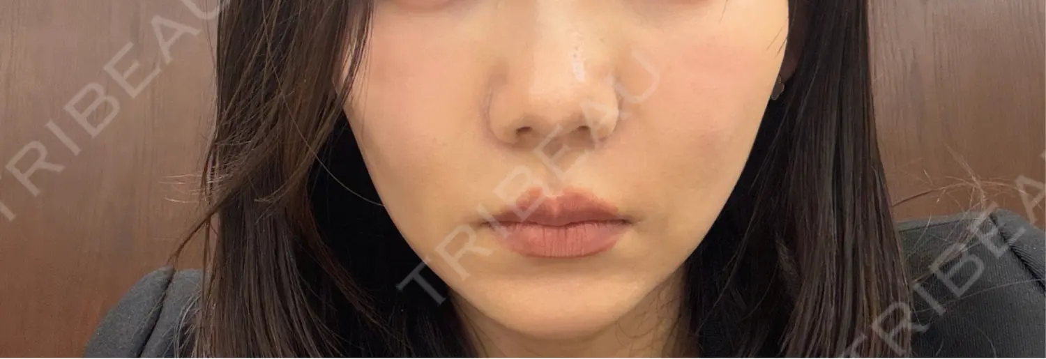施術後の写真