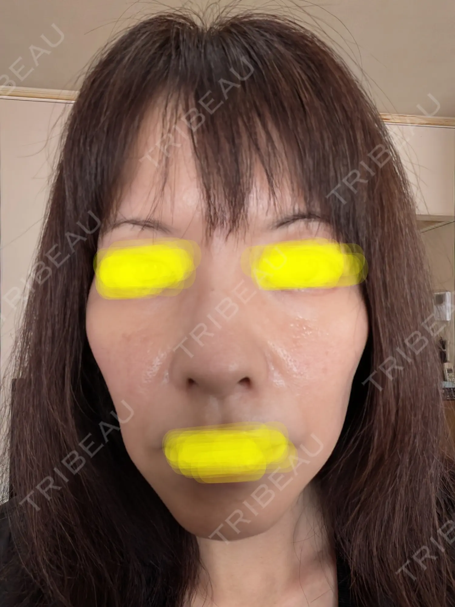 施術後の写真