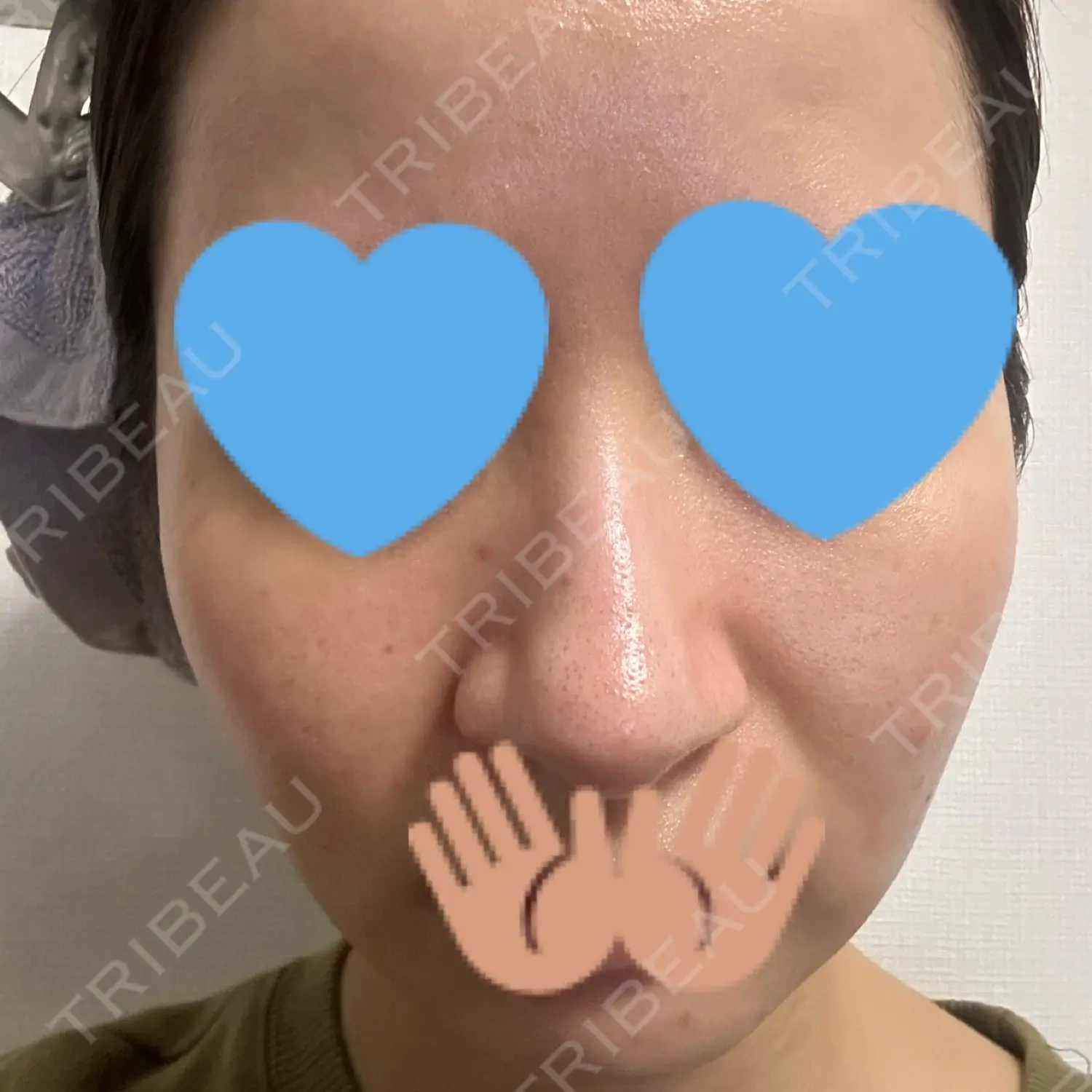 施術後の写真