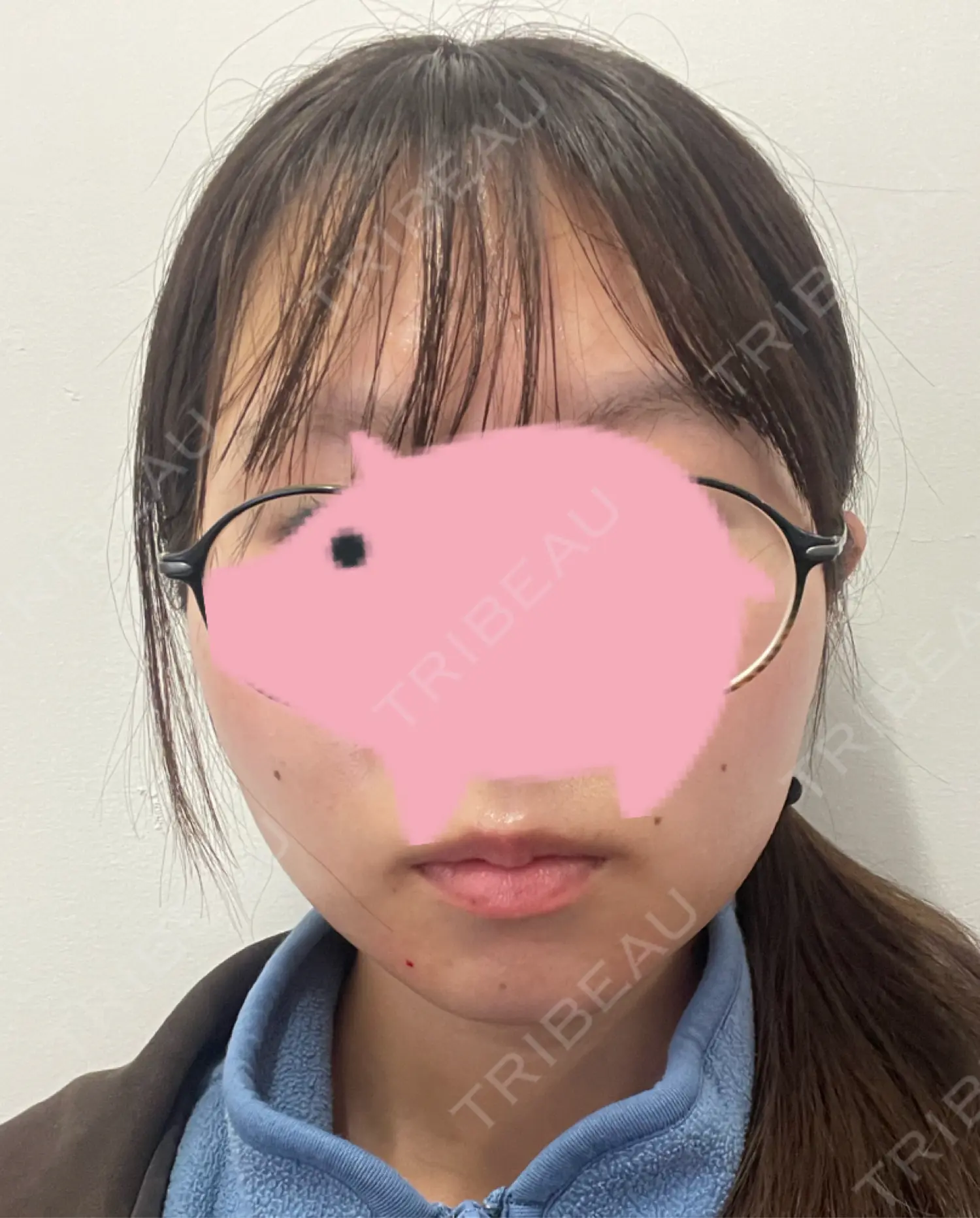 施術後の写真