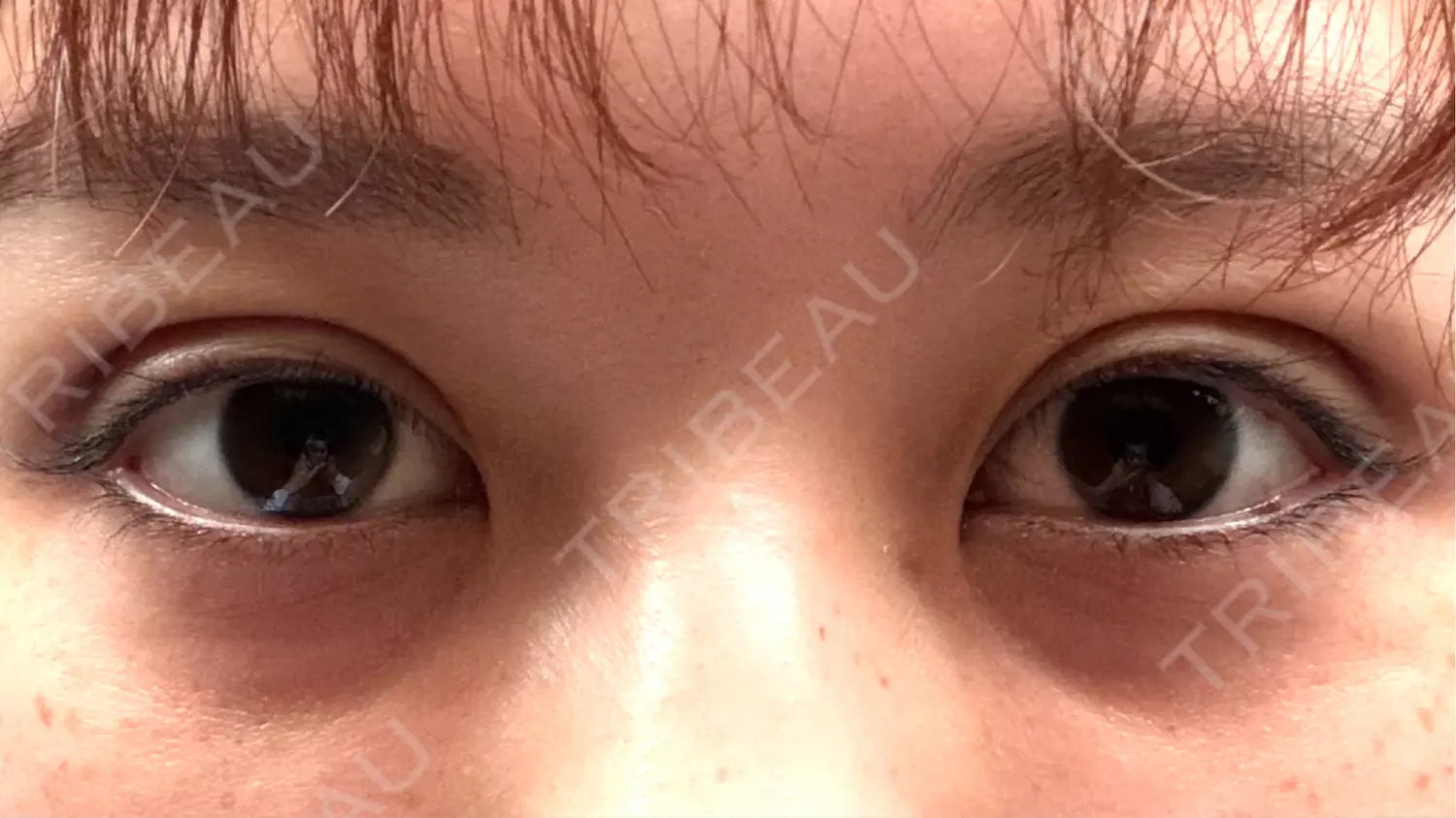 施術後の写真