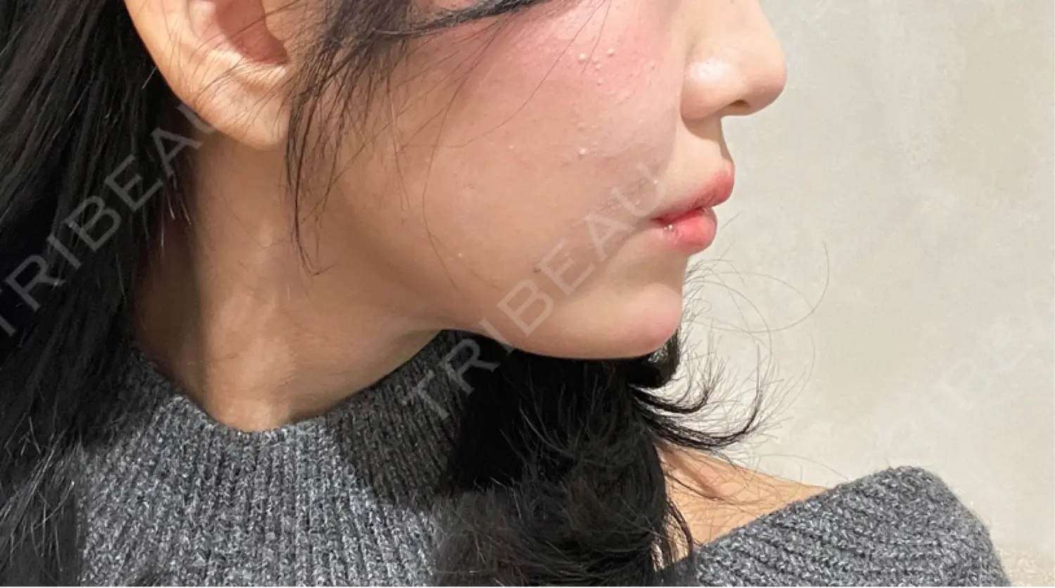 施術後の写真