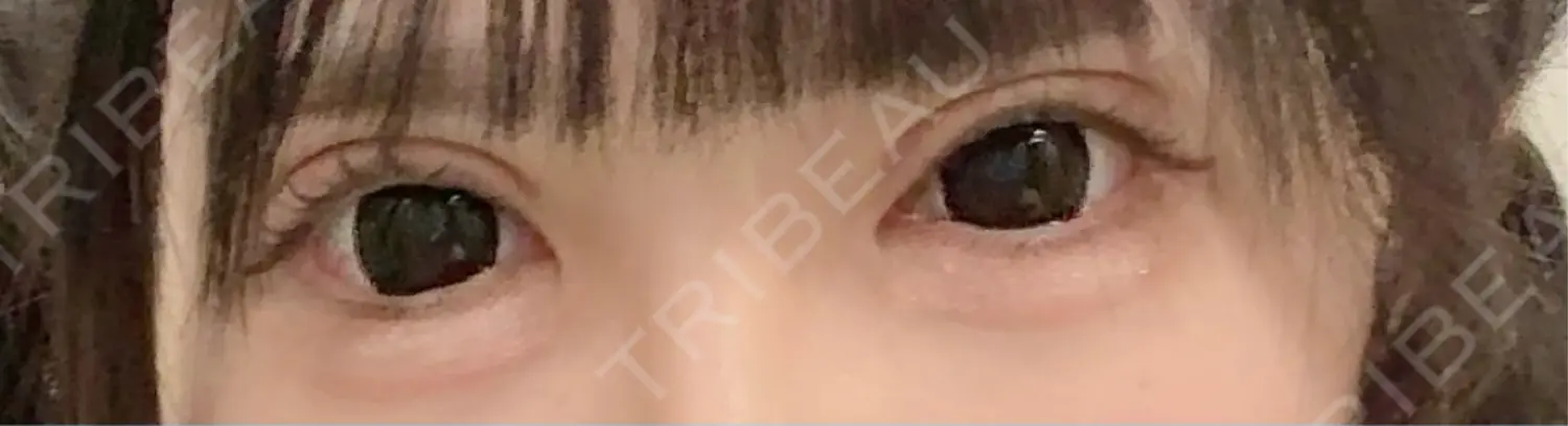 施術後の写真