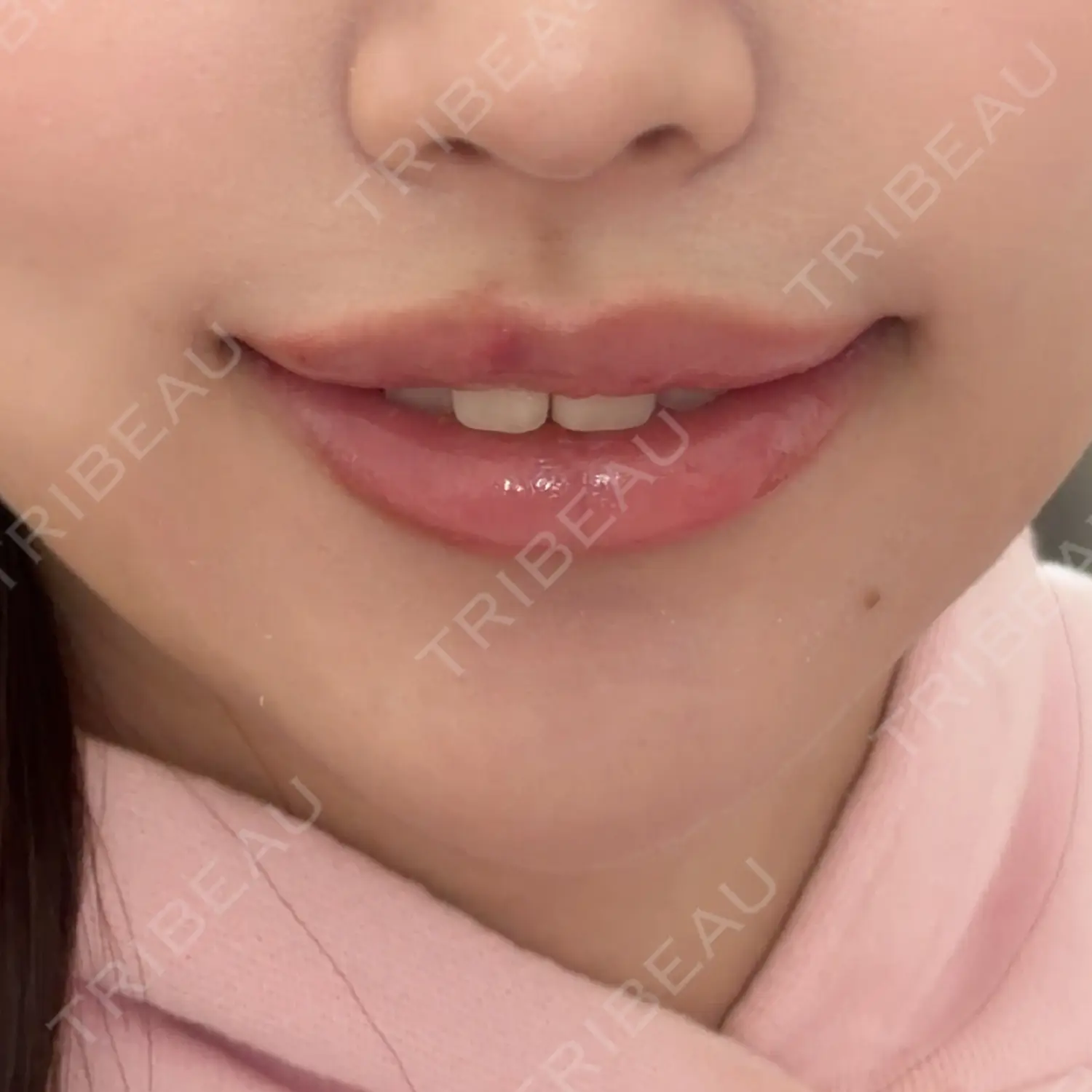 施術後の写真