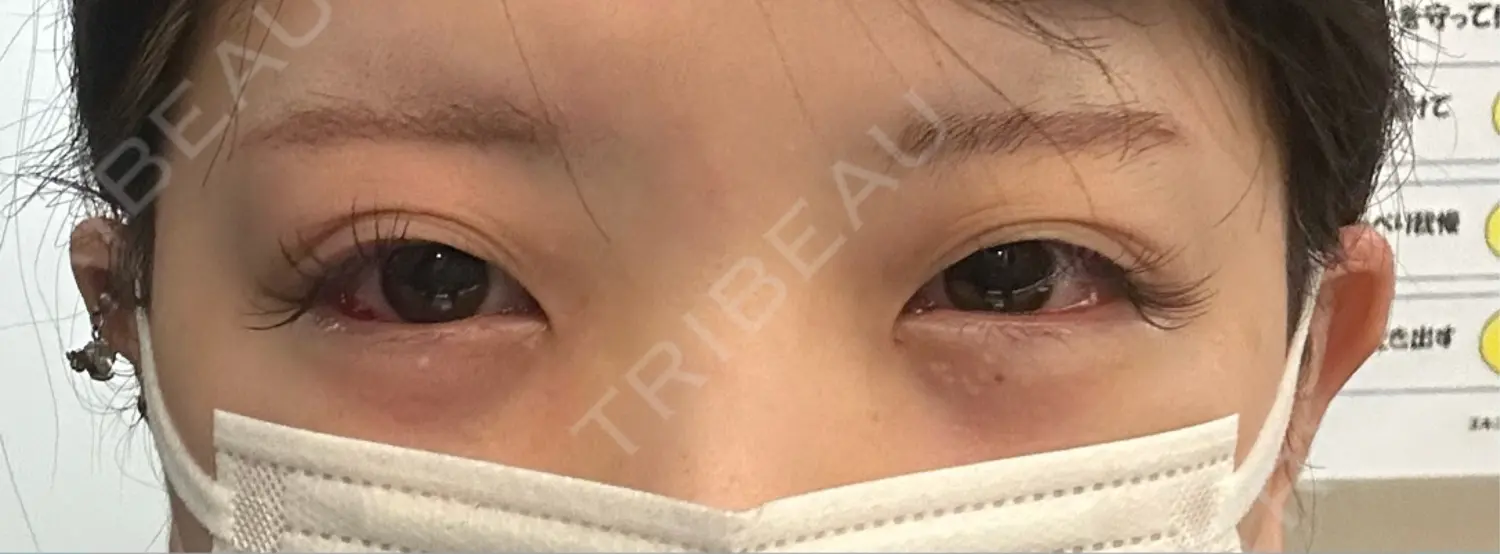 施術後の写真