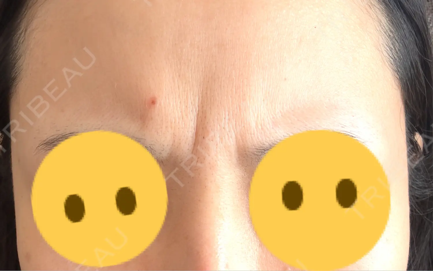 施術後の写真