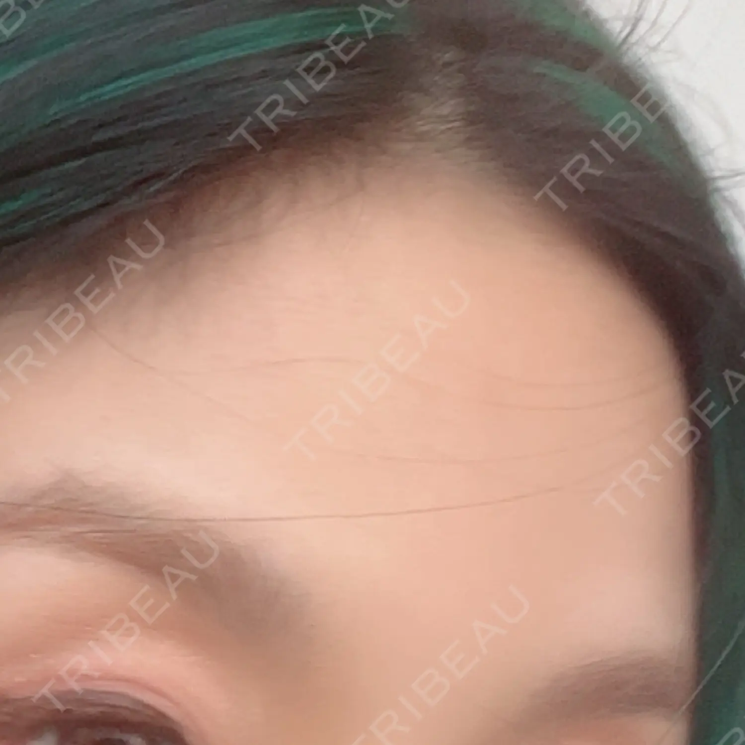 施術後の写真