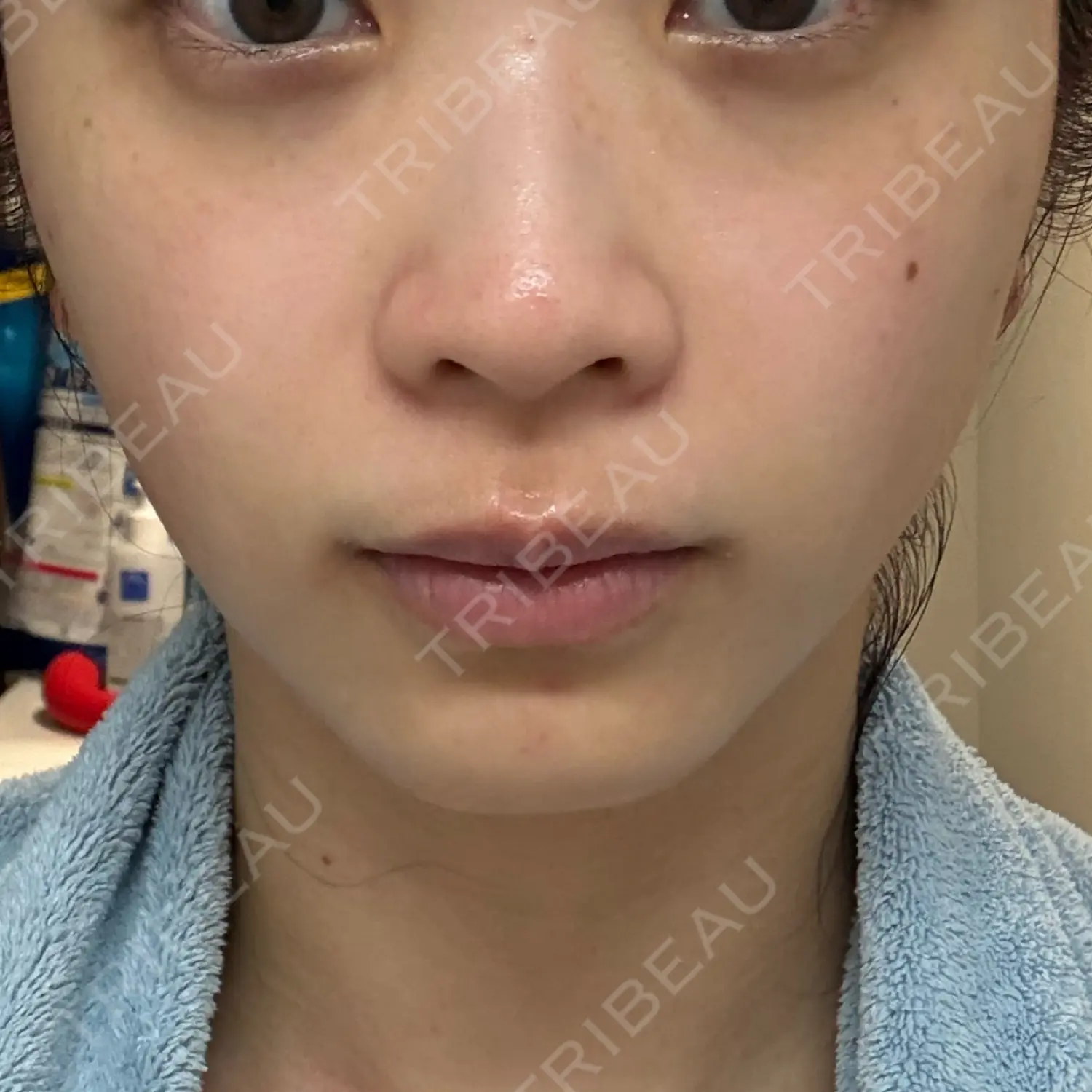 施術後の写真