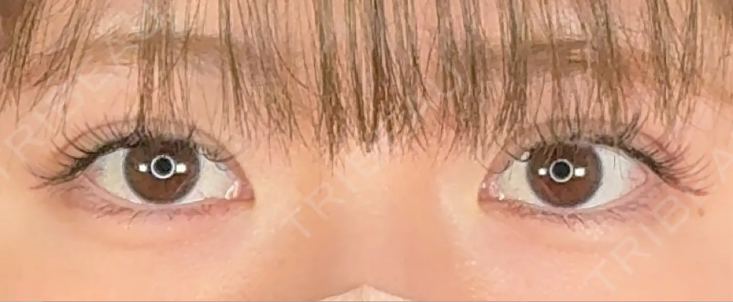 施術後の写真