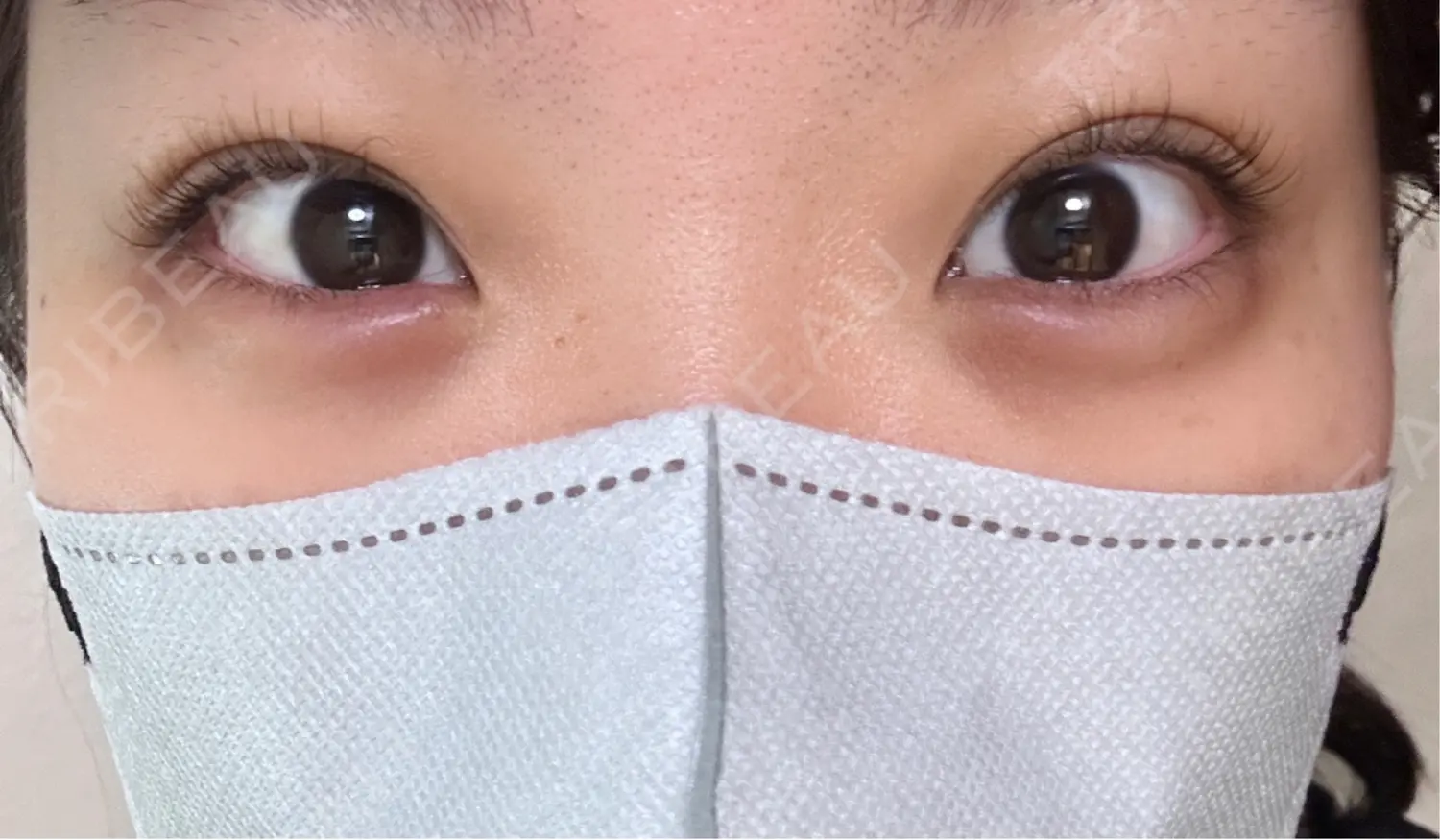 施術後の写真