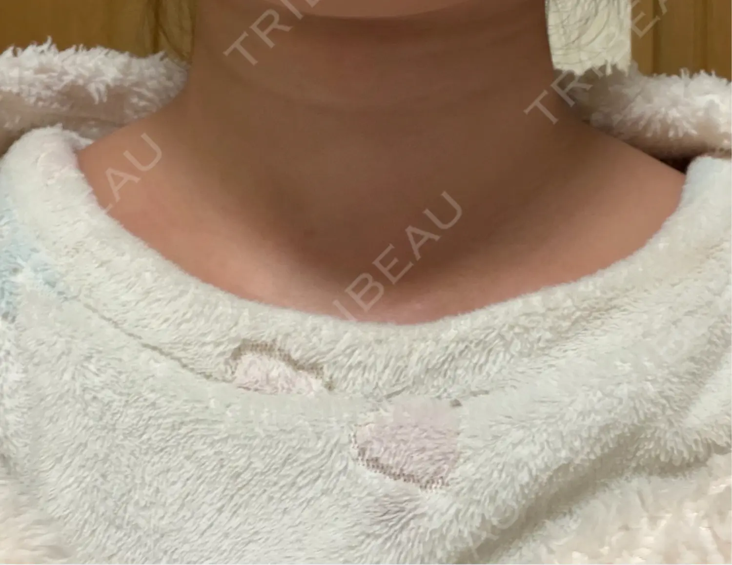 施術後の写真