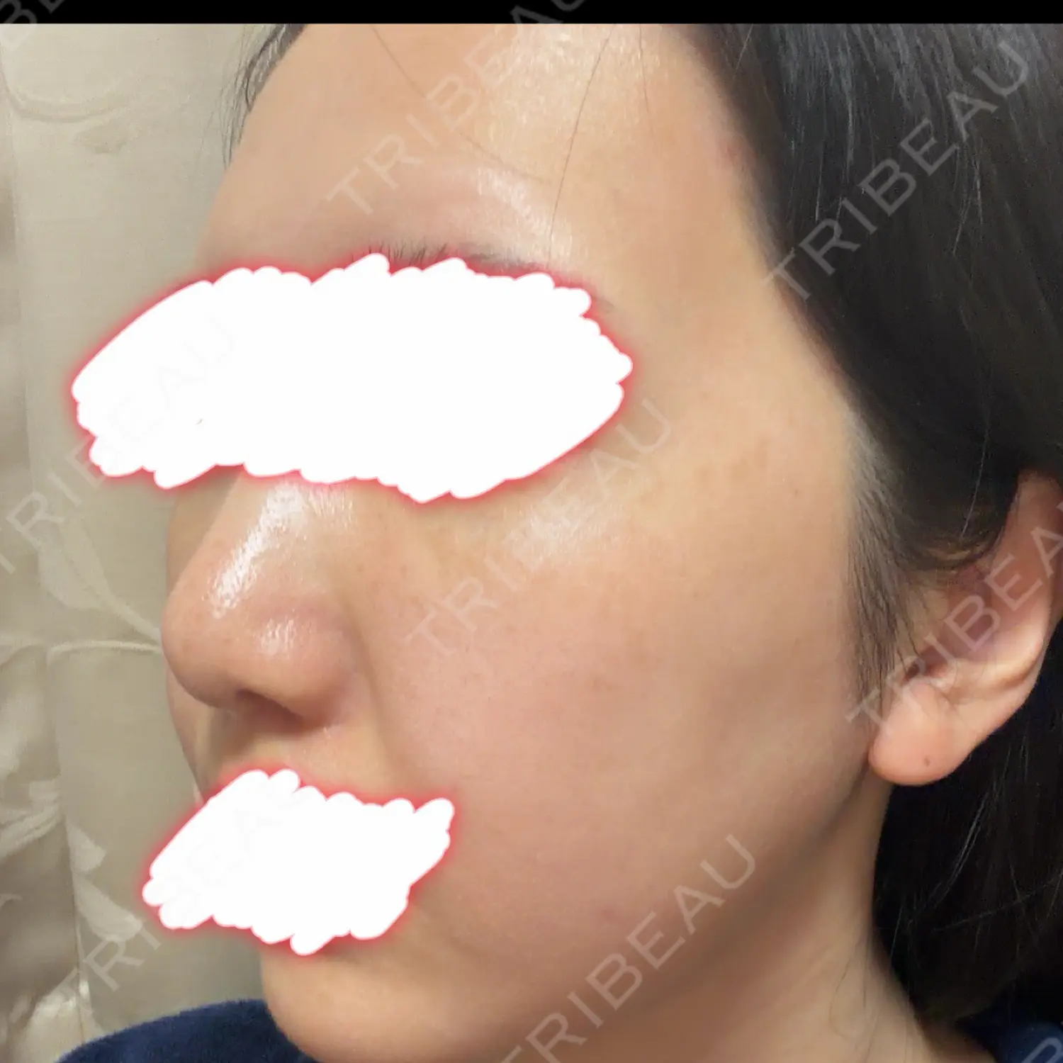 施術後の写真
