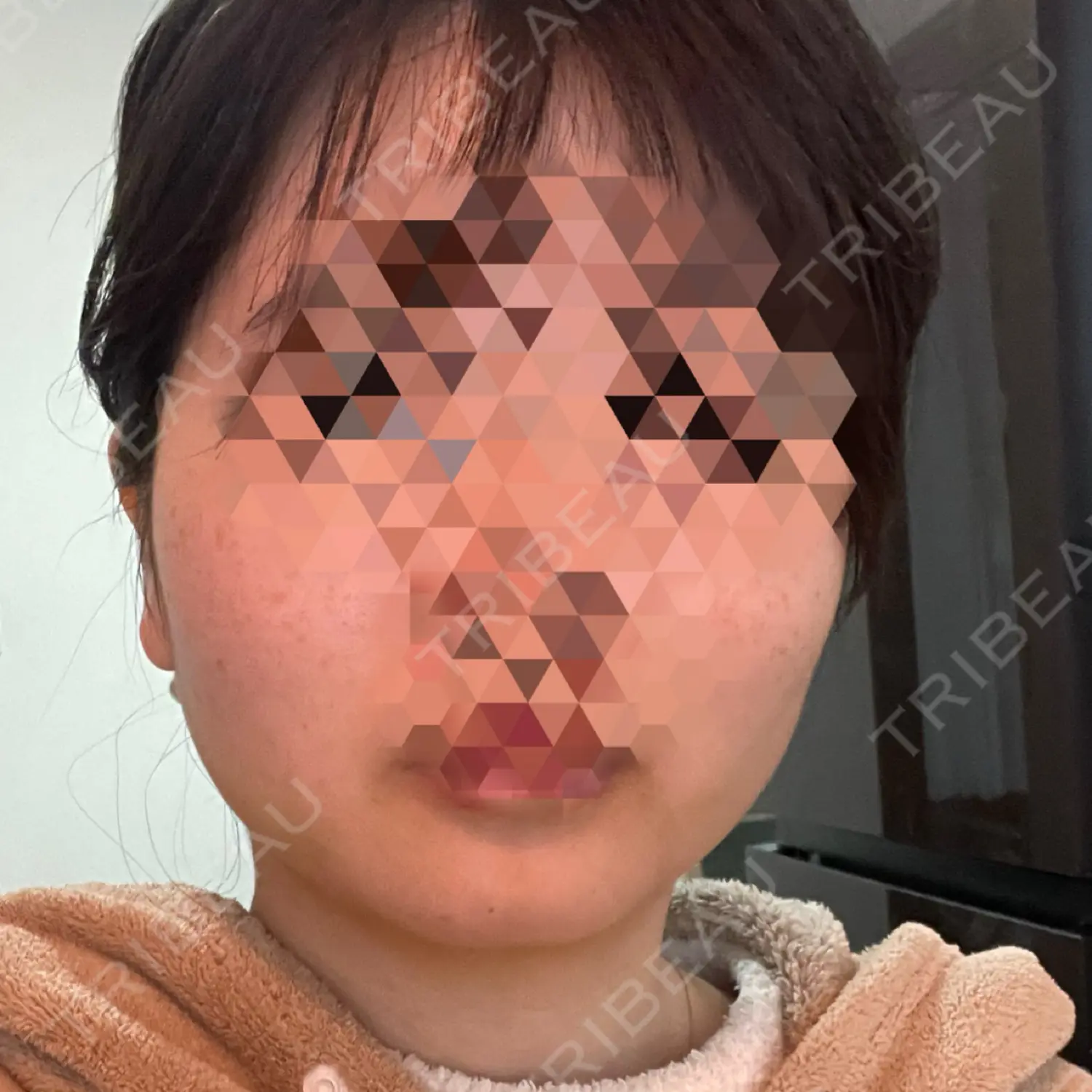 施術後の写真