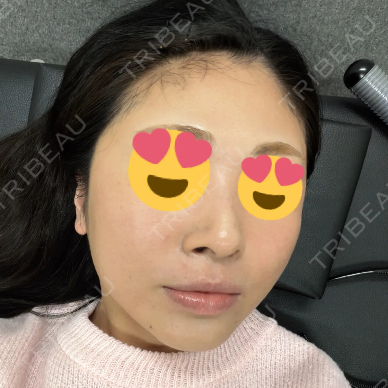 施術後の写真