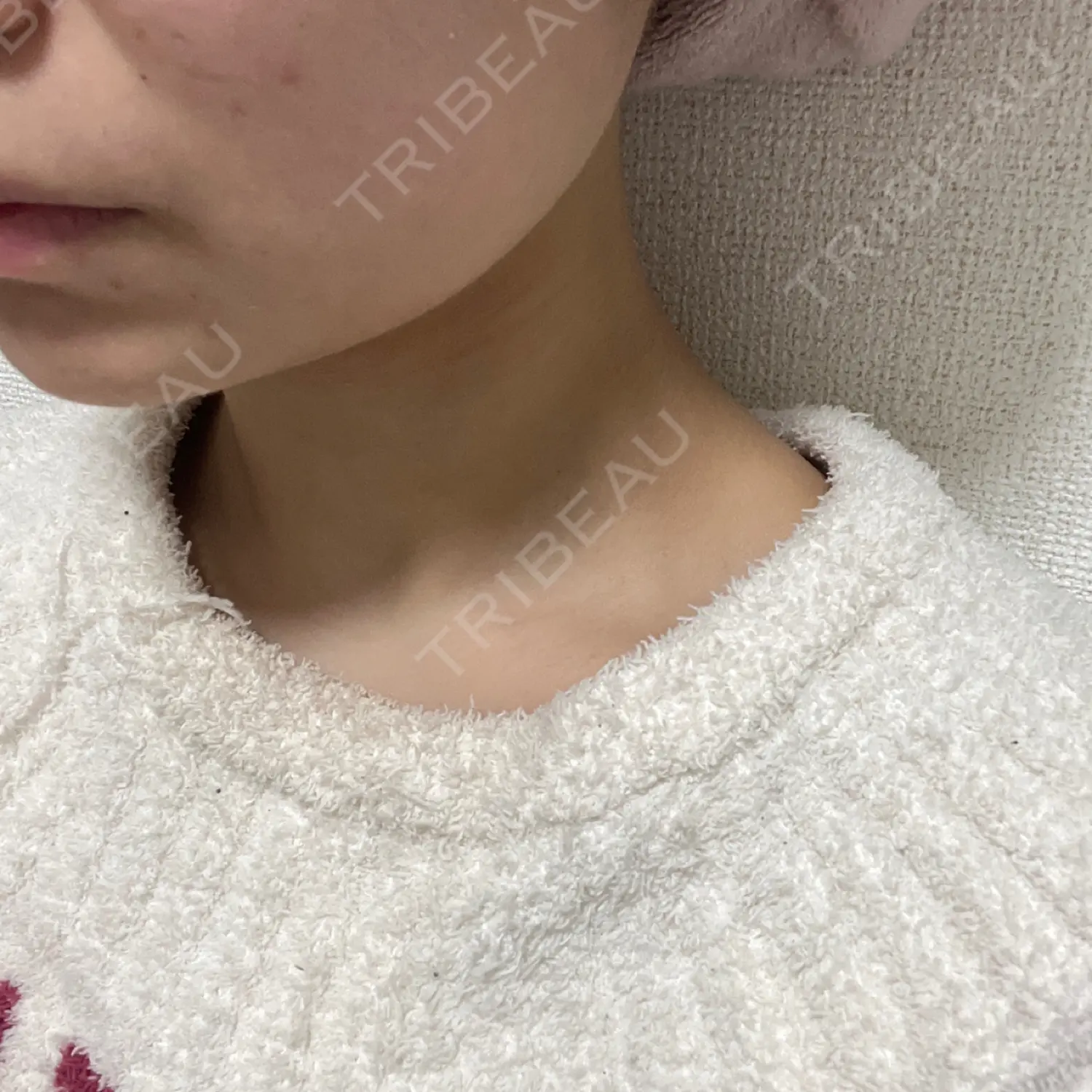 施術後の写真