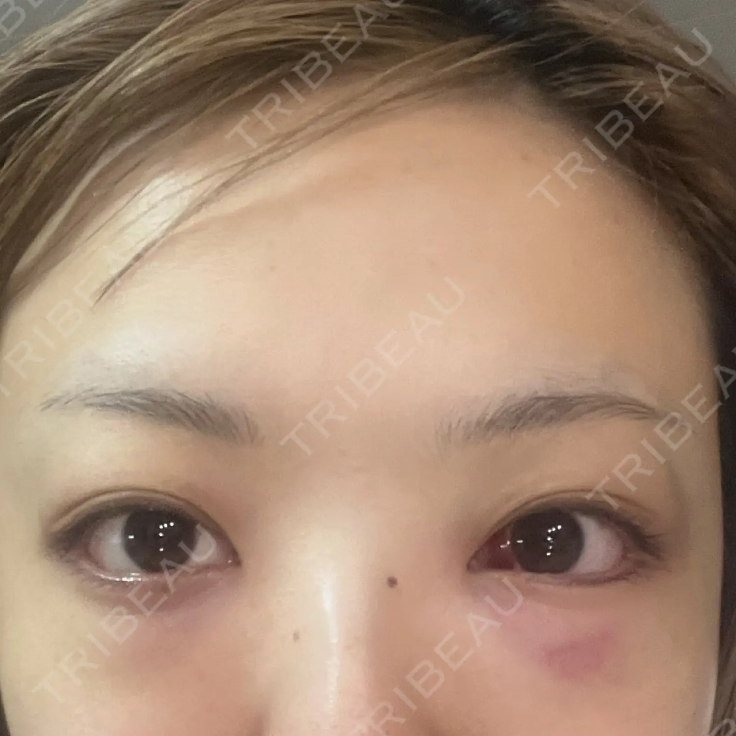 施術後の写真