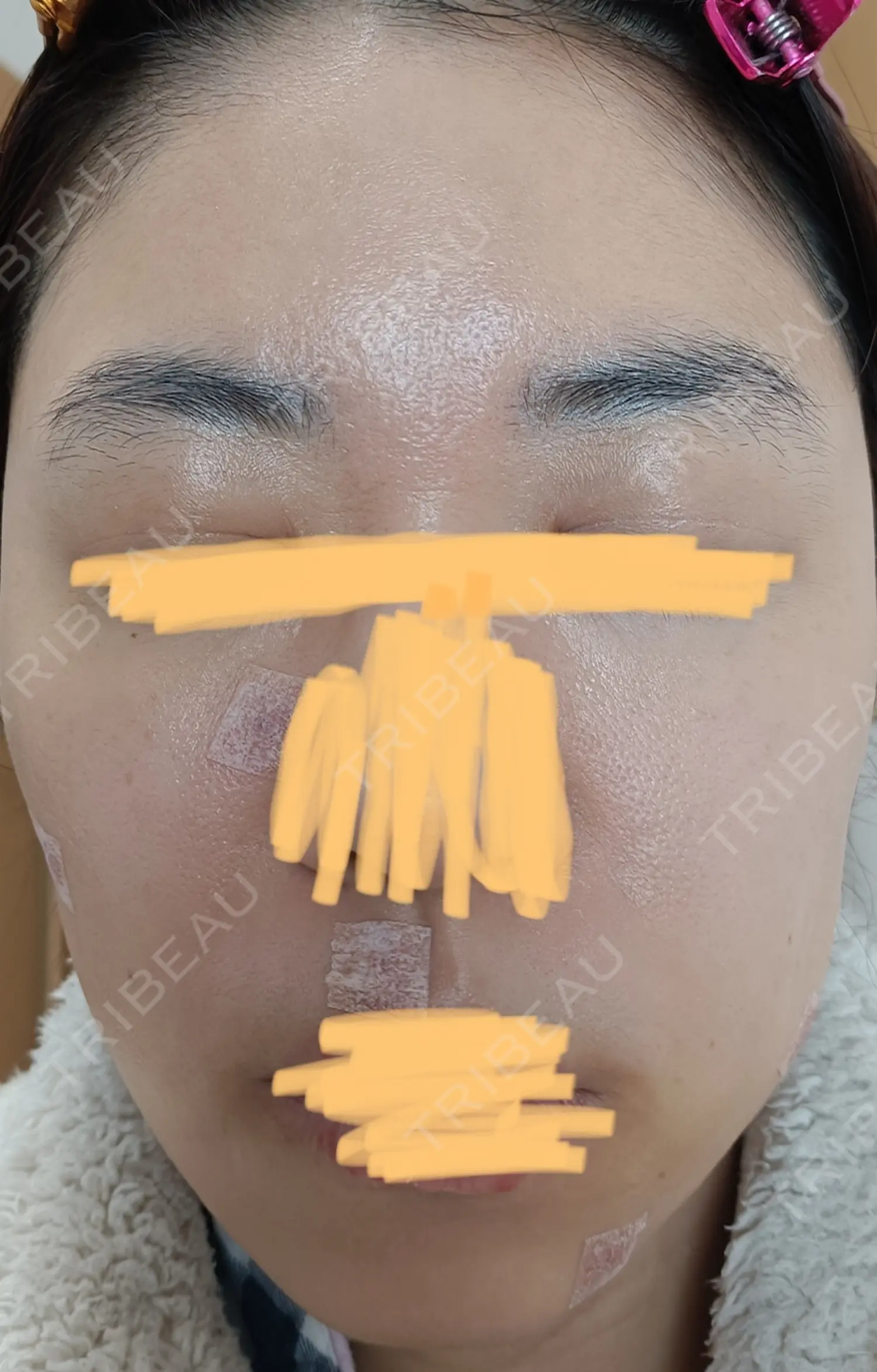 施術後の写真