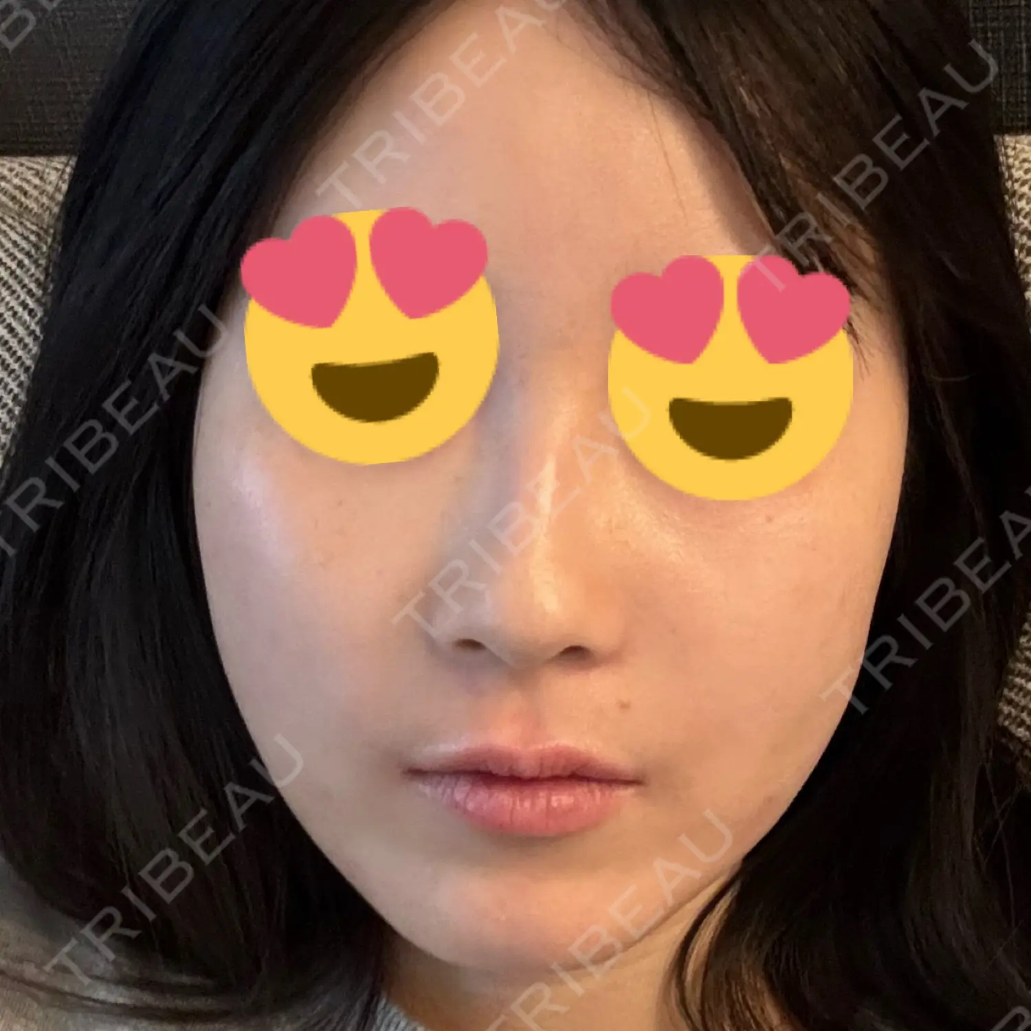 施術後の写真