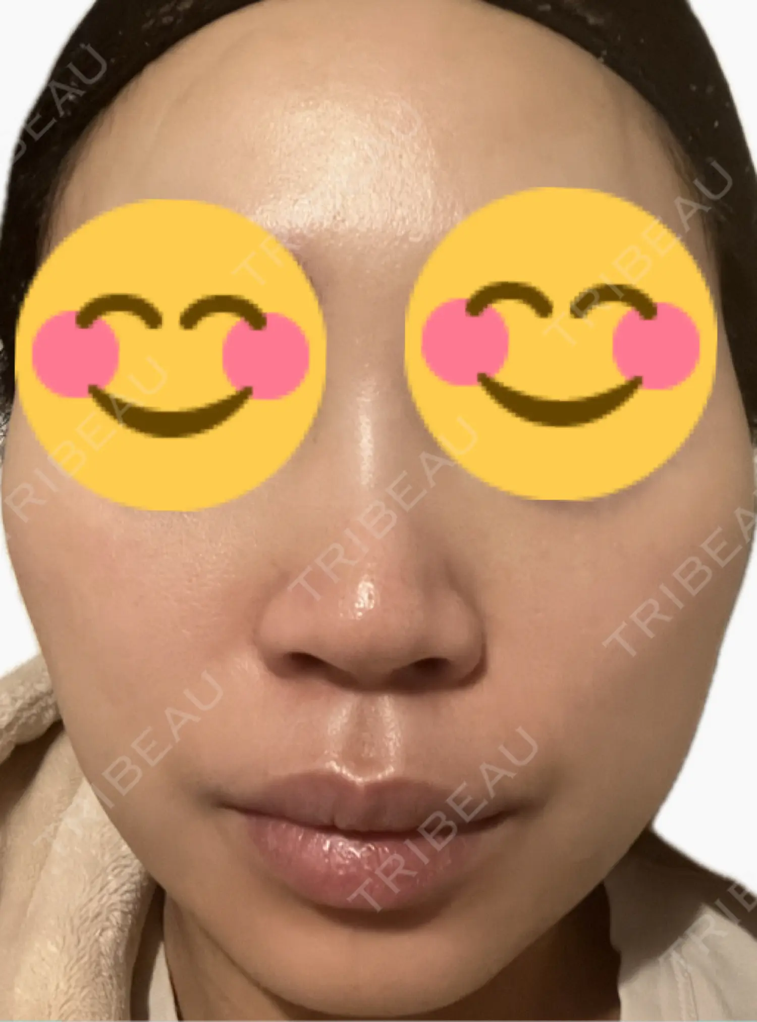 施術後の写真