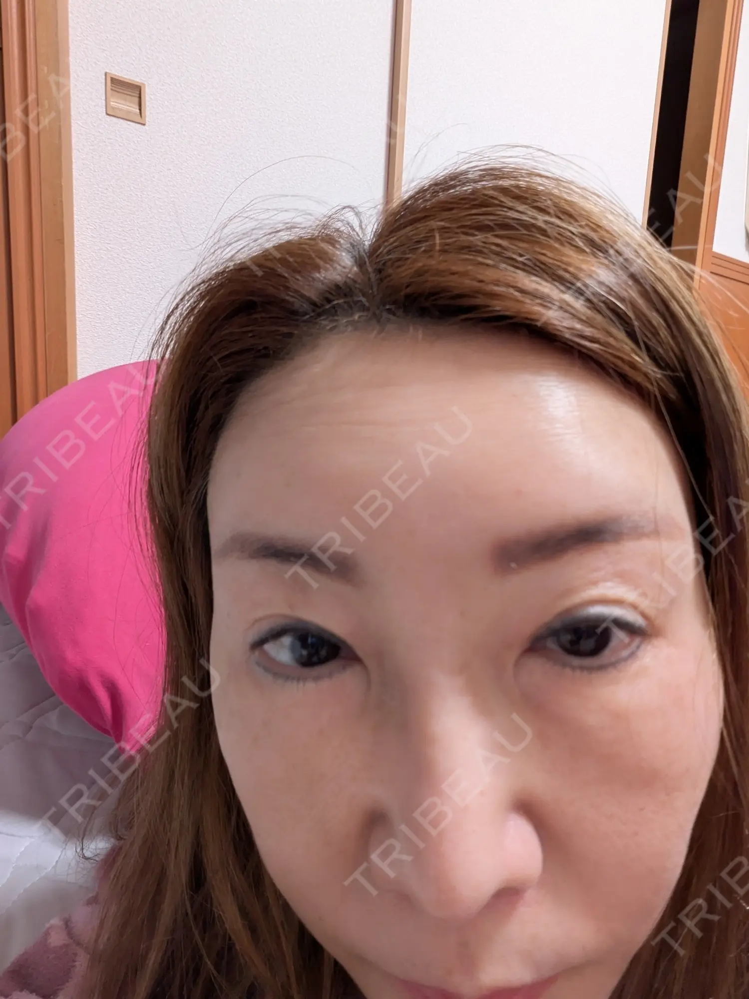 施術後の写真
