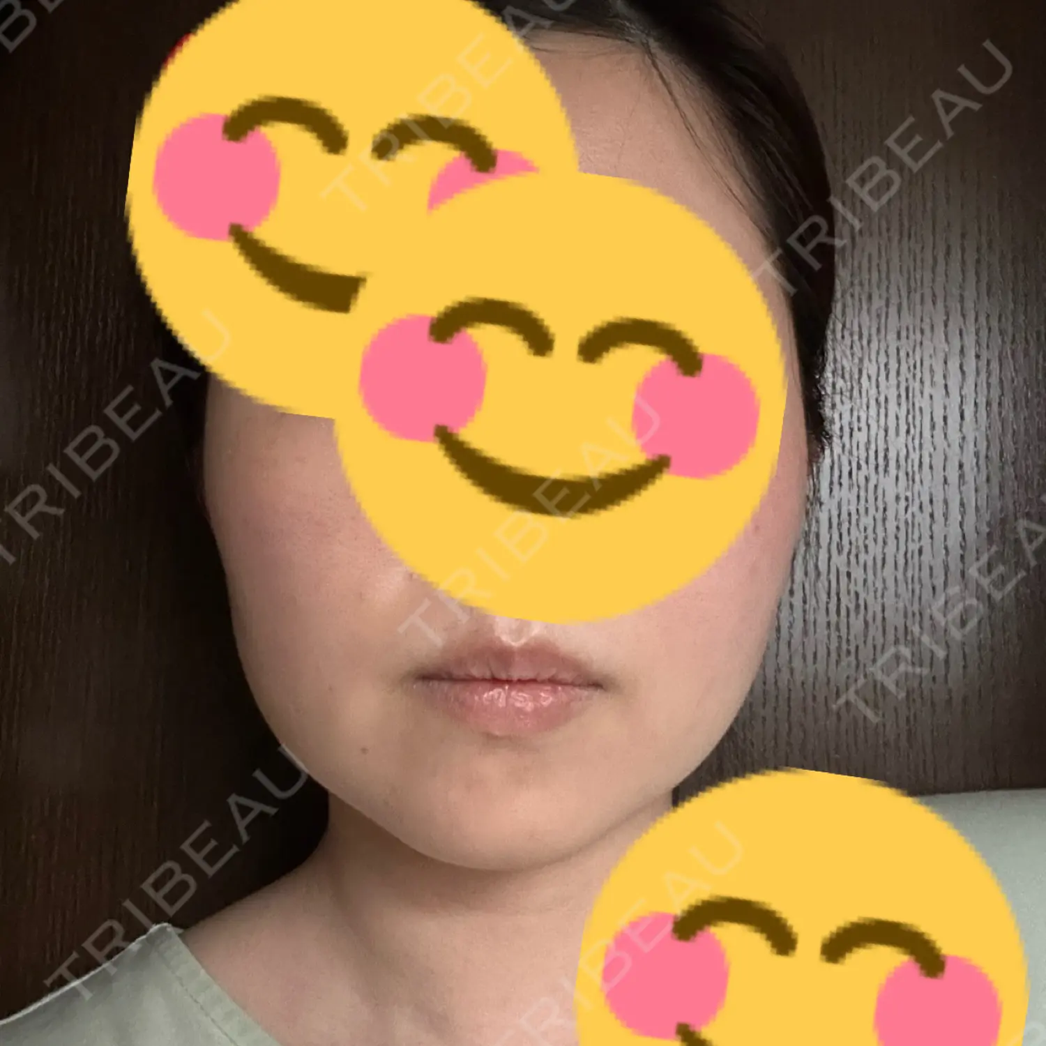施術後の写真