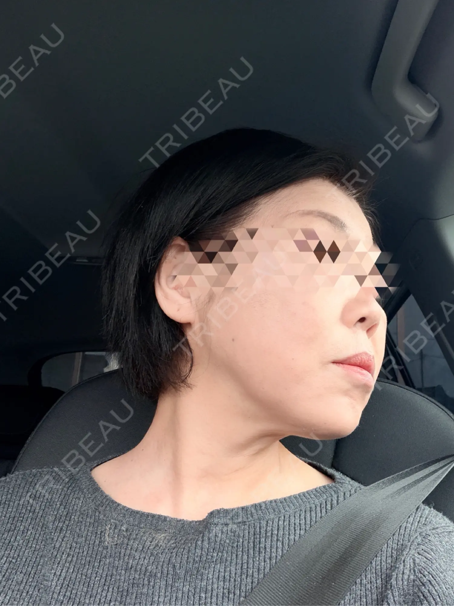 施術後の写真