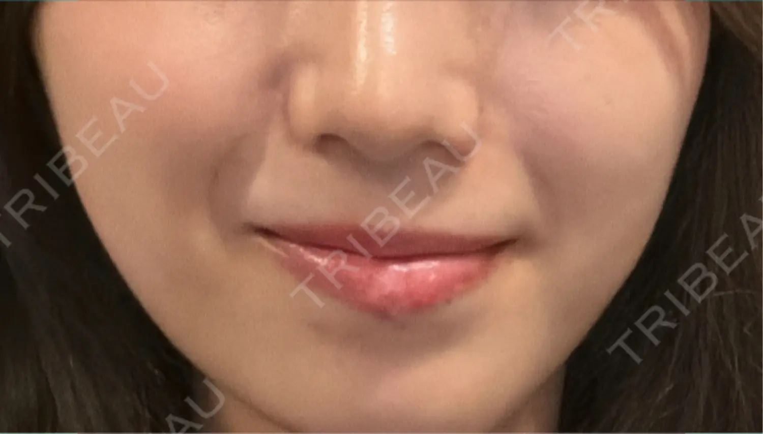施術後の写真