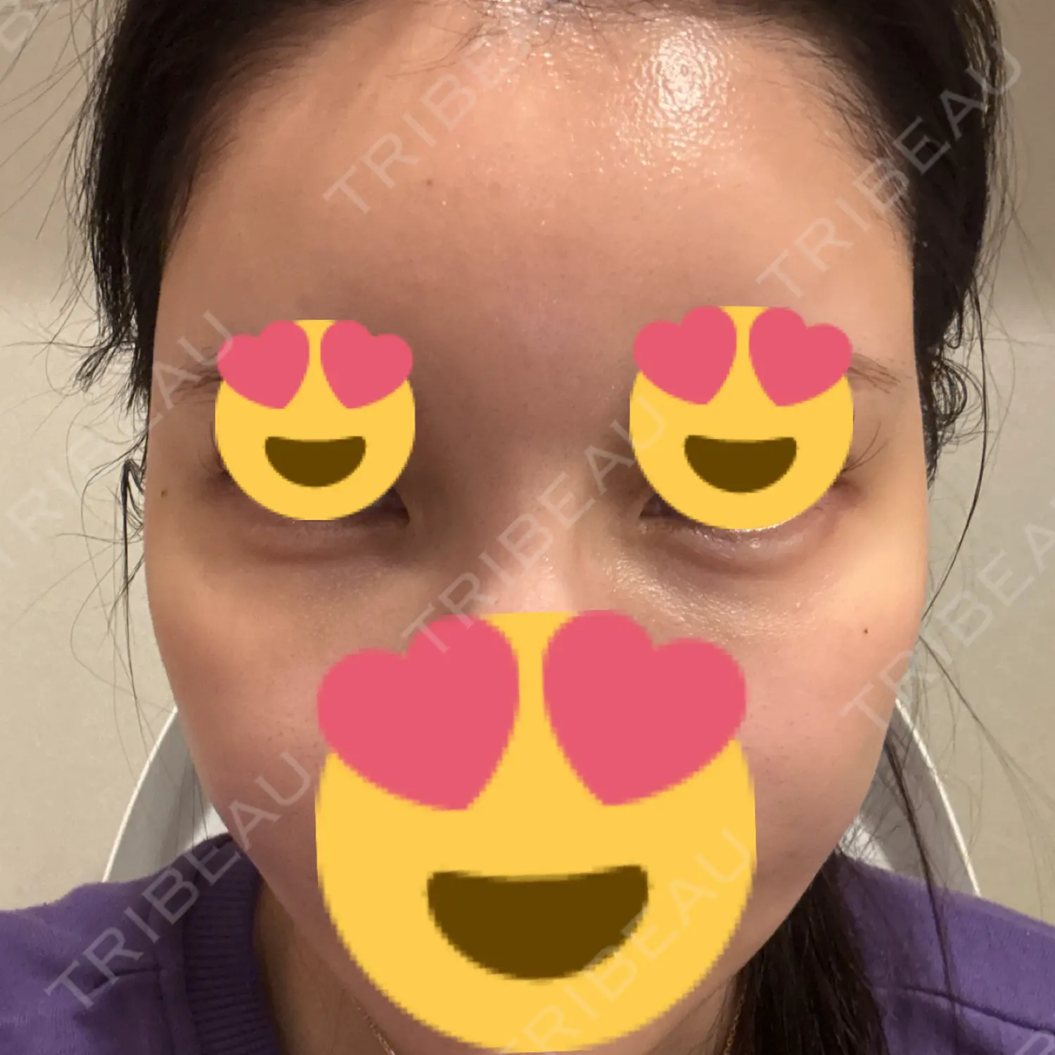 施術後の写真