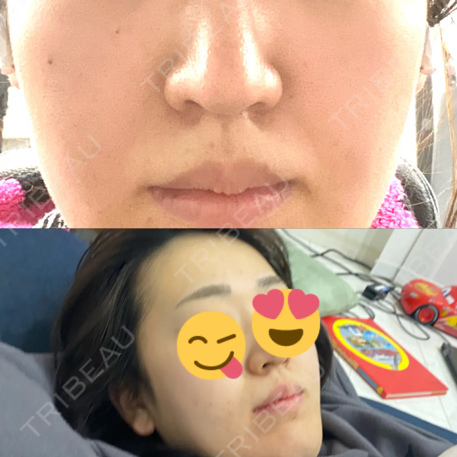 施術後の写真