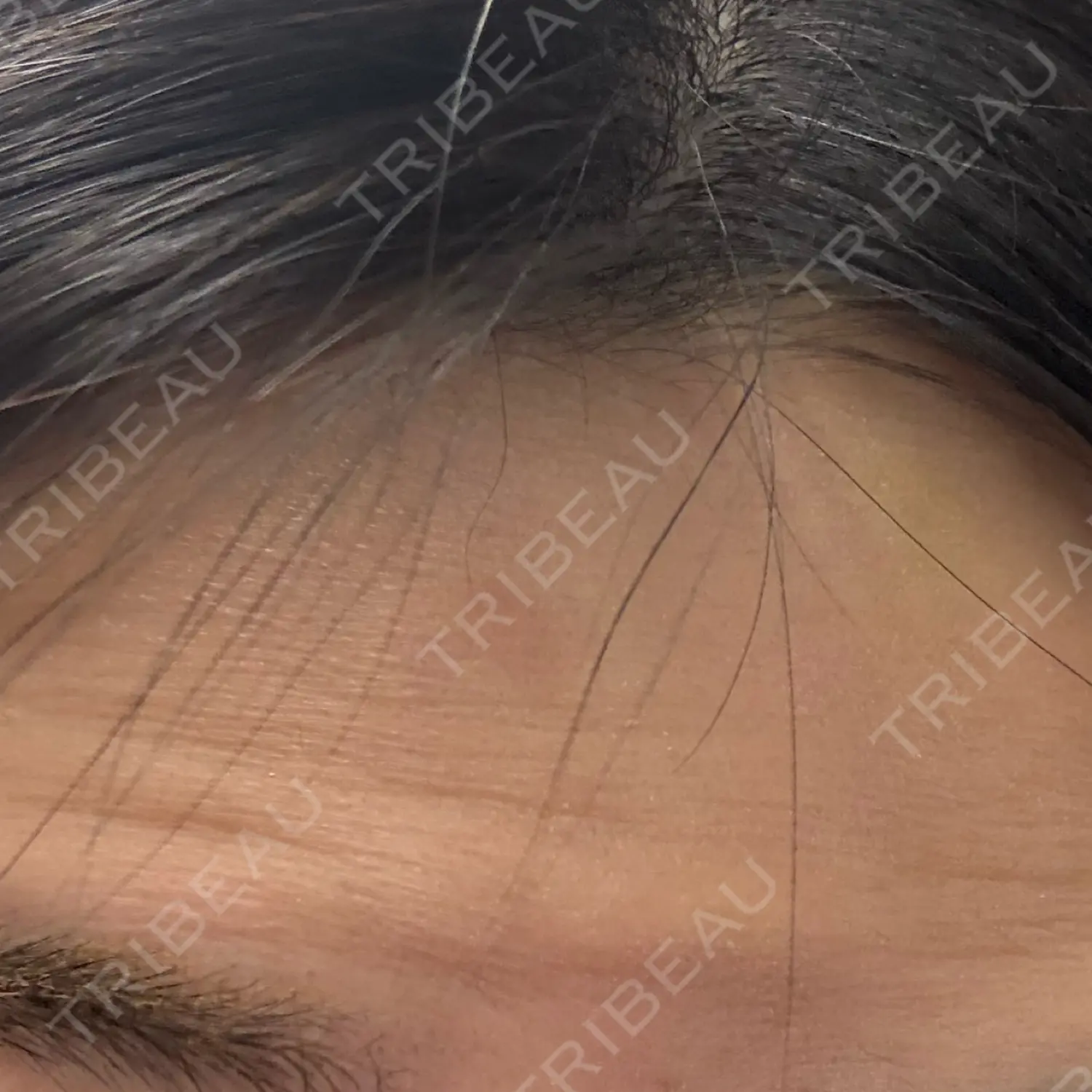 施術後の写真