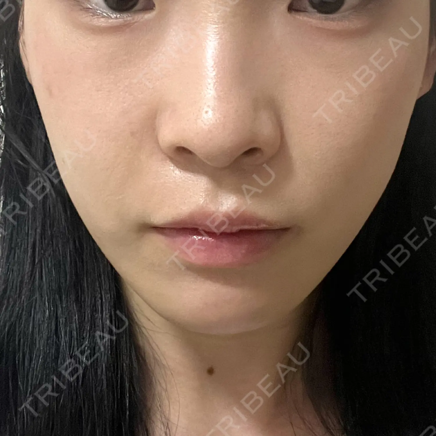 施術後の写真