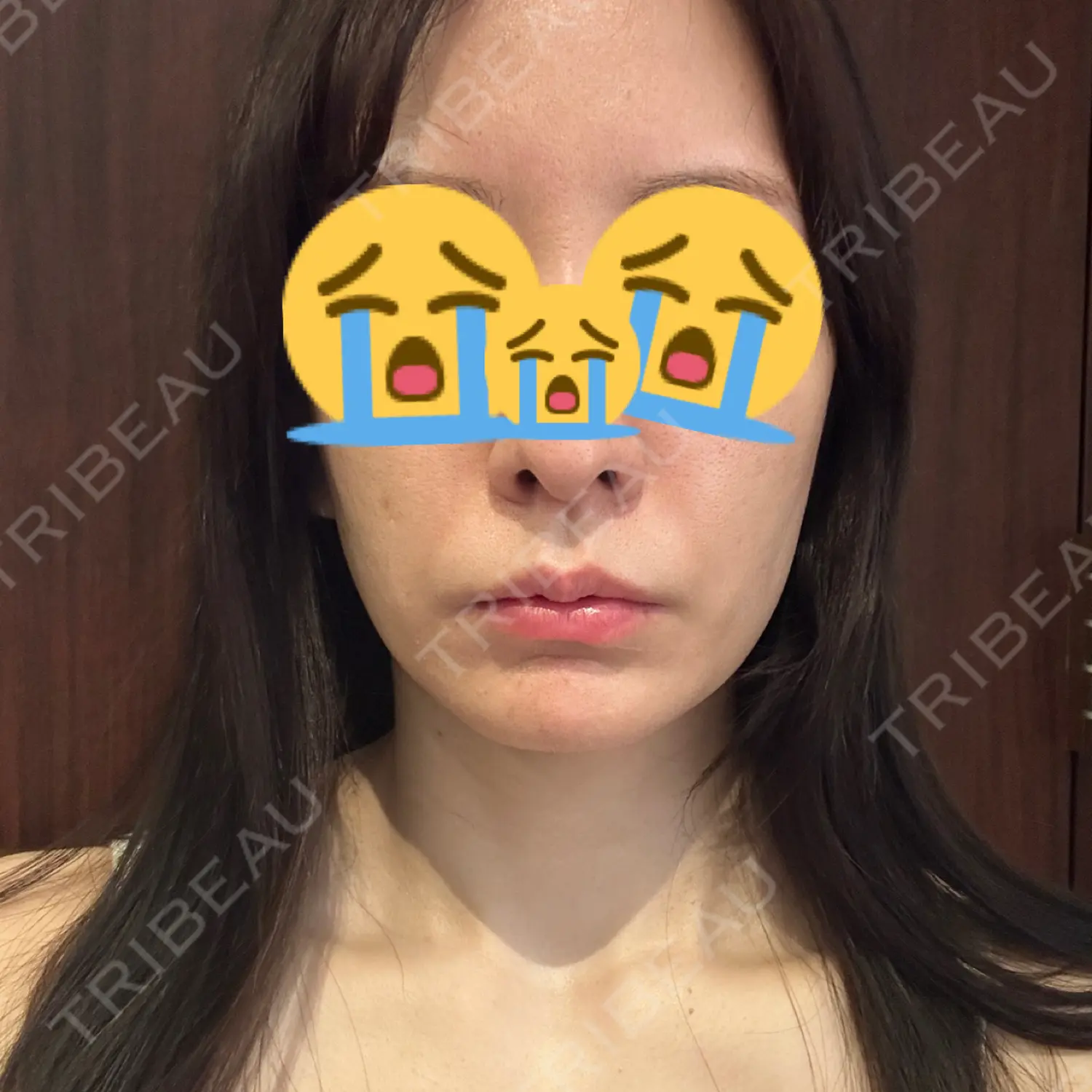 施術後の写真