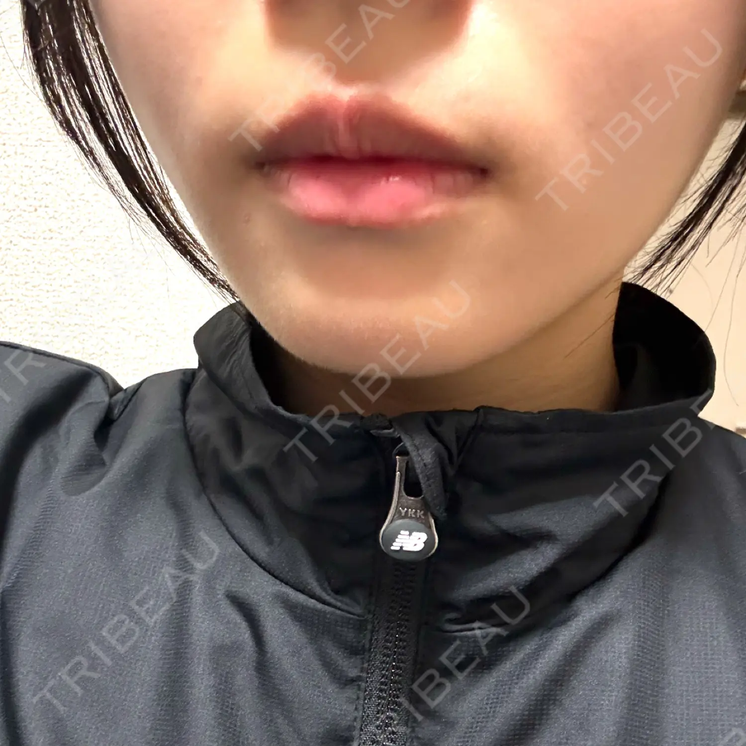 施術後の写真