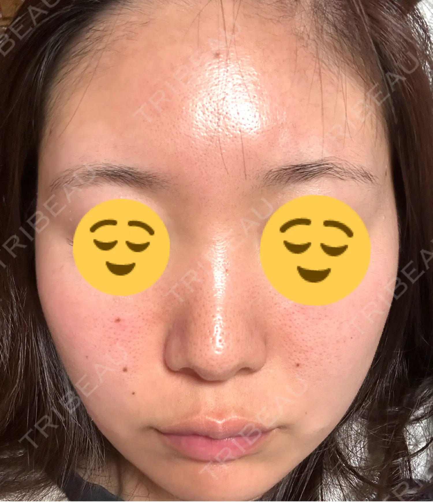 施術後の写真