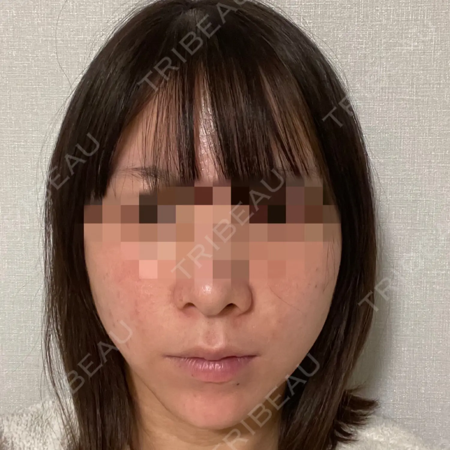 施術後の写真
