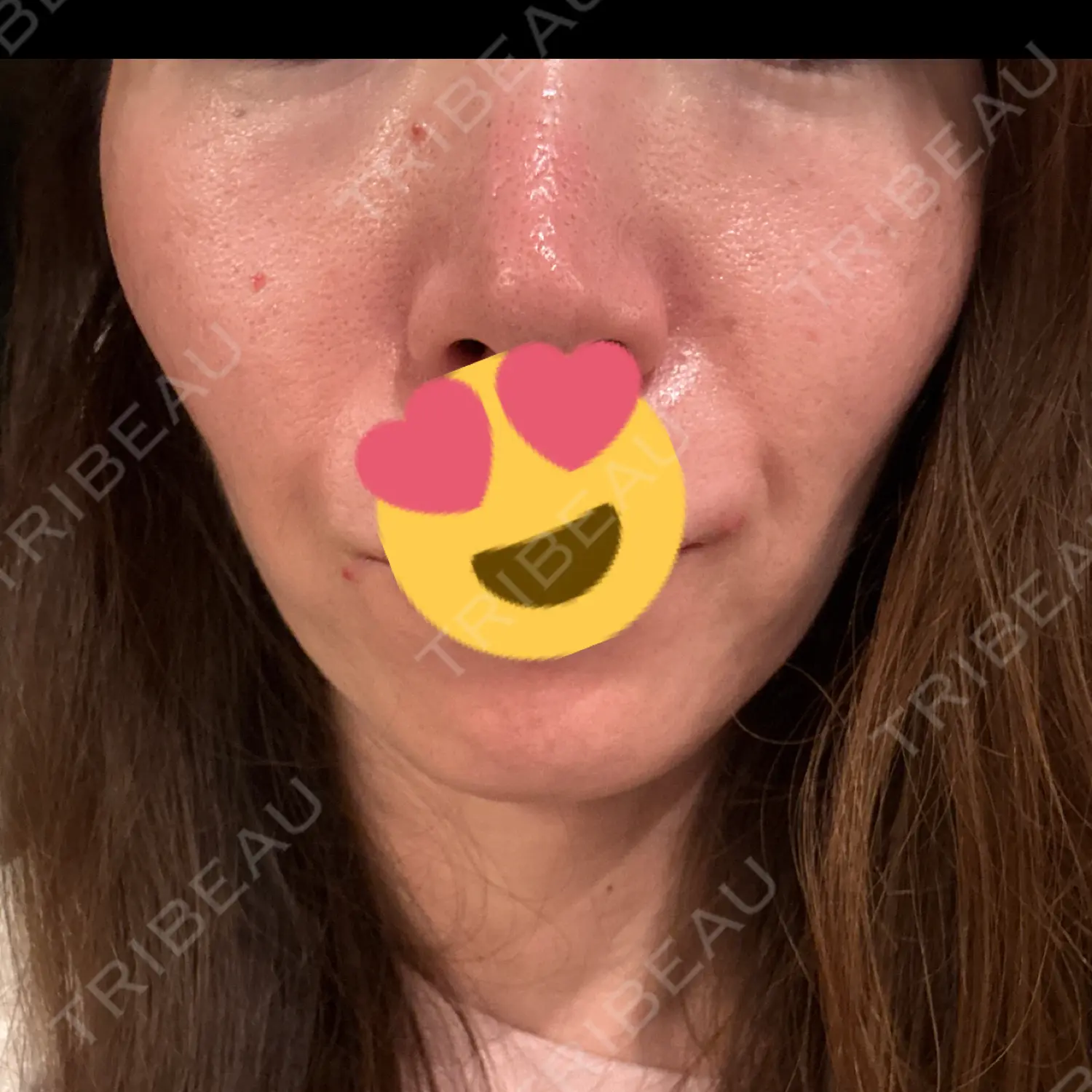 施術後の写真