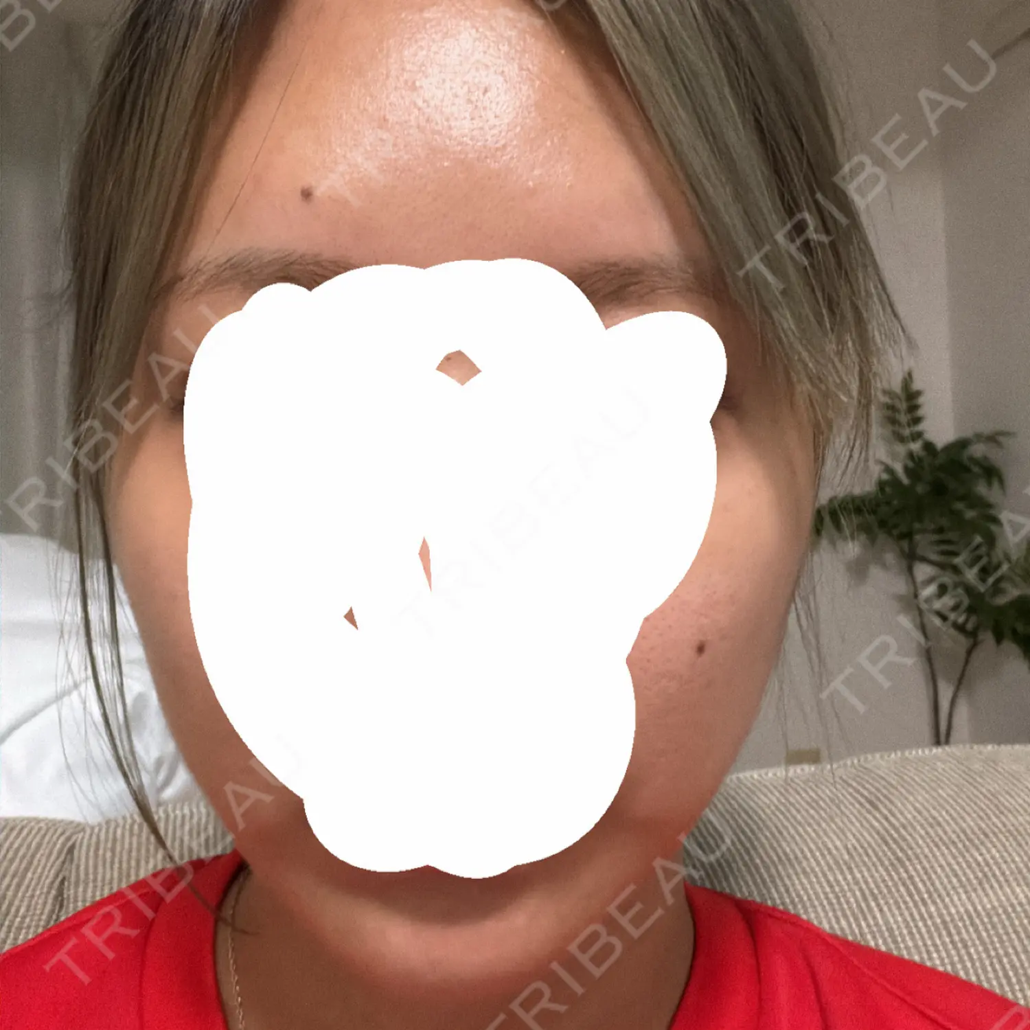 施術後の写真