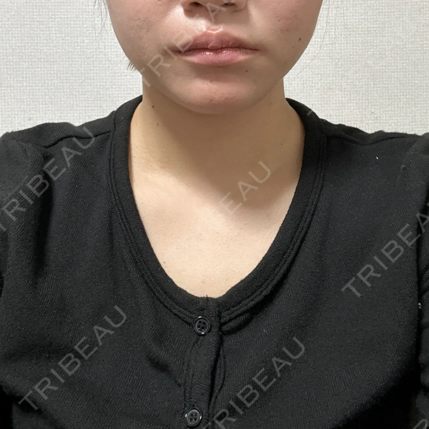 施術後の写真
